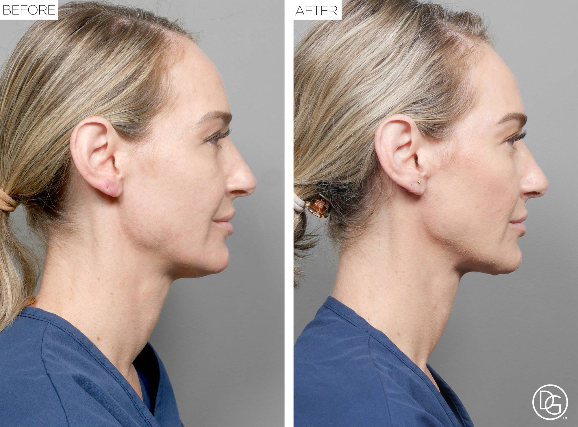 Weekend Lift Before & After Image