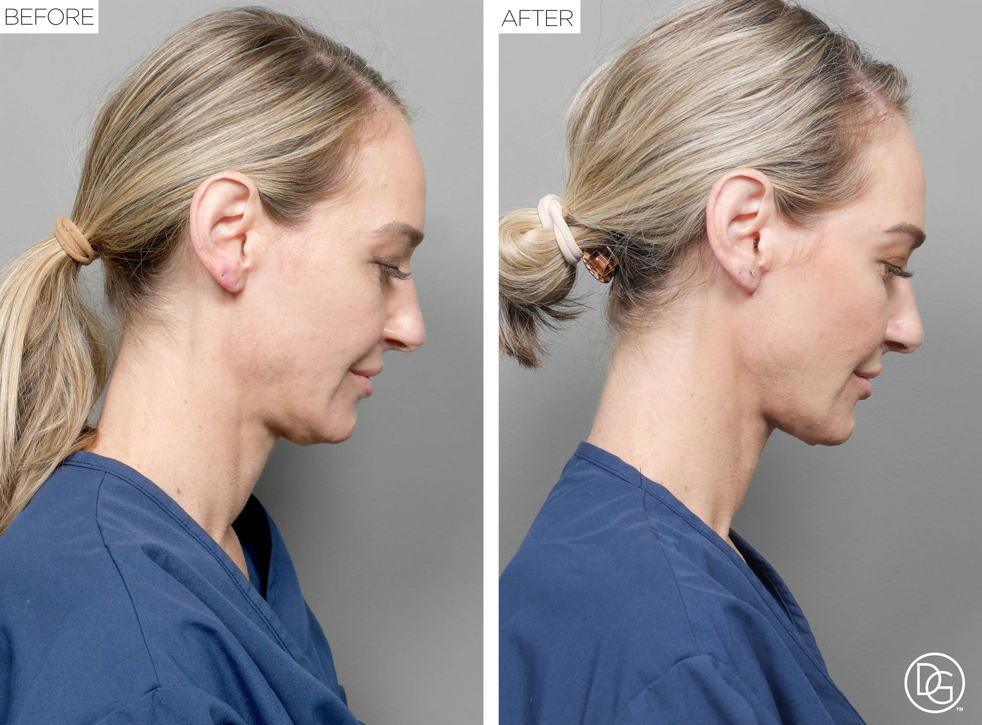 Weekend Lift Before & After Image