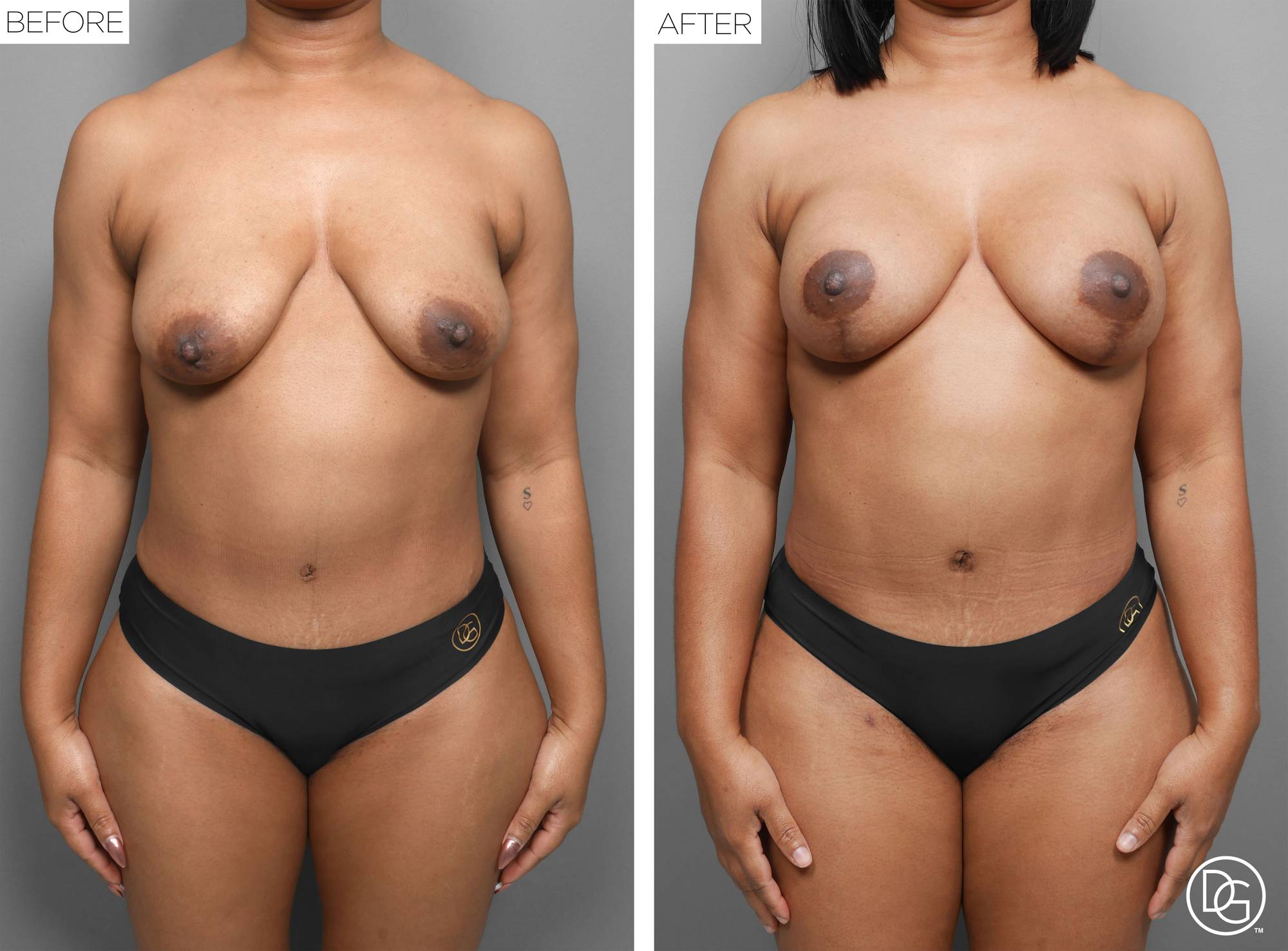 Liposuction Before & After Image