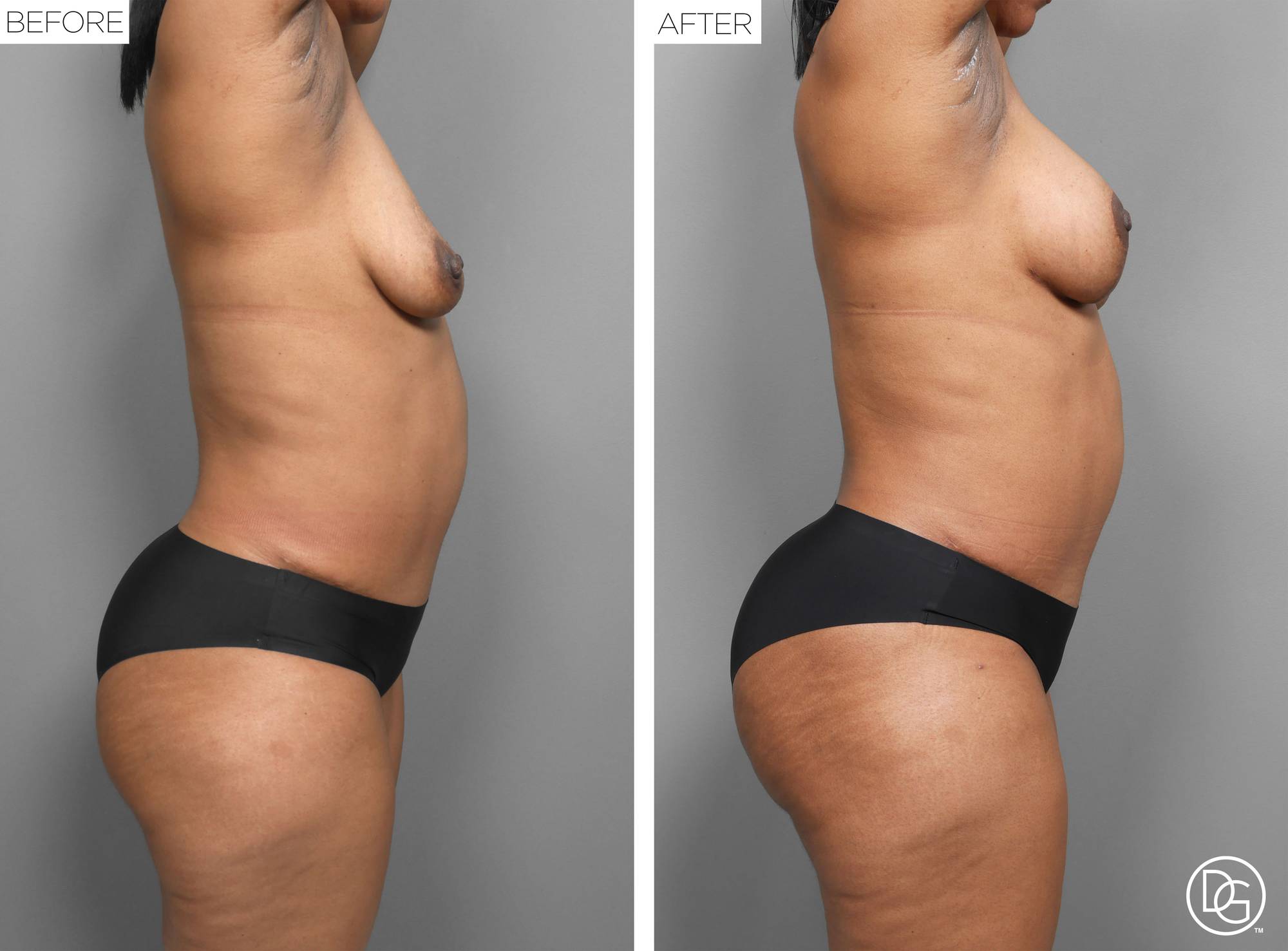 Liposuction Before & After Image
