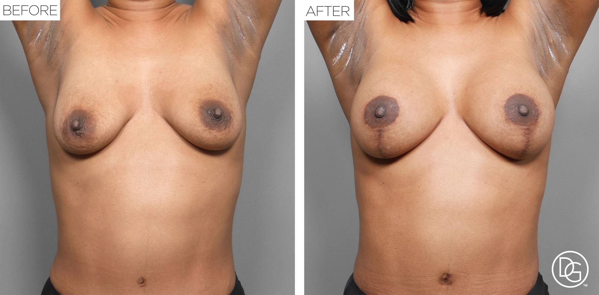 Breast Lift Before & After Image