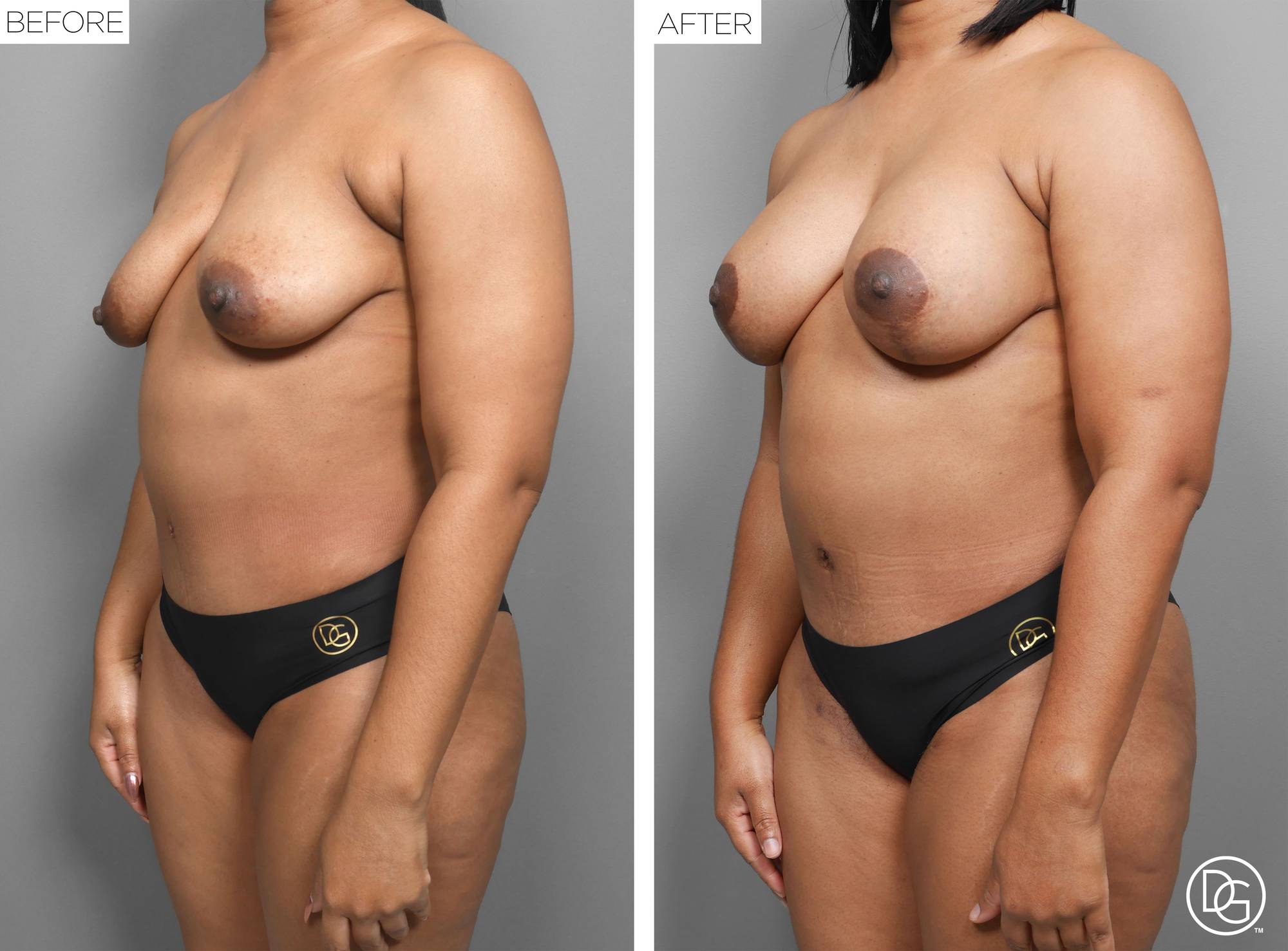 Liposuction Before & After Image