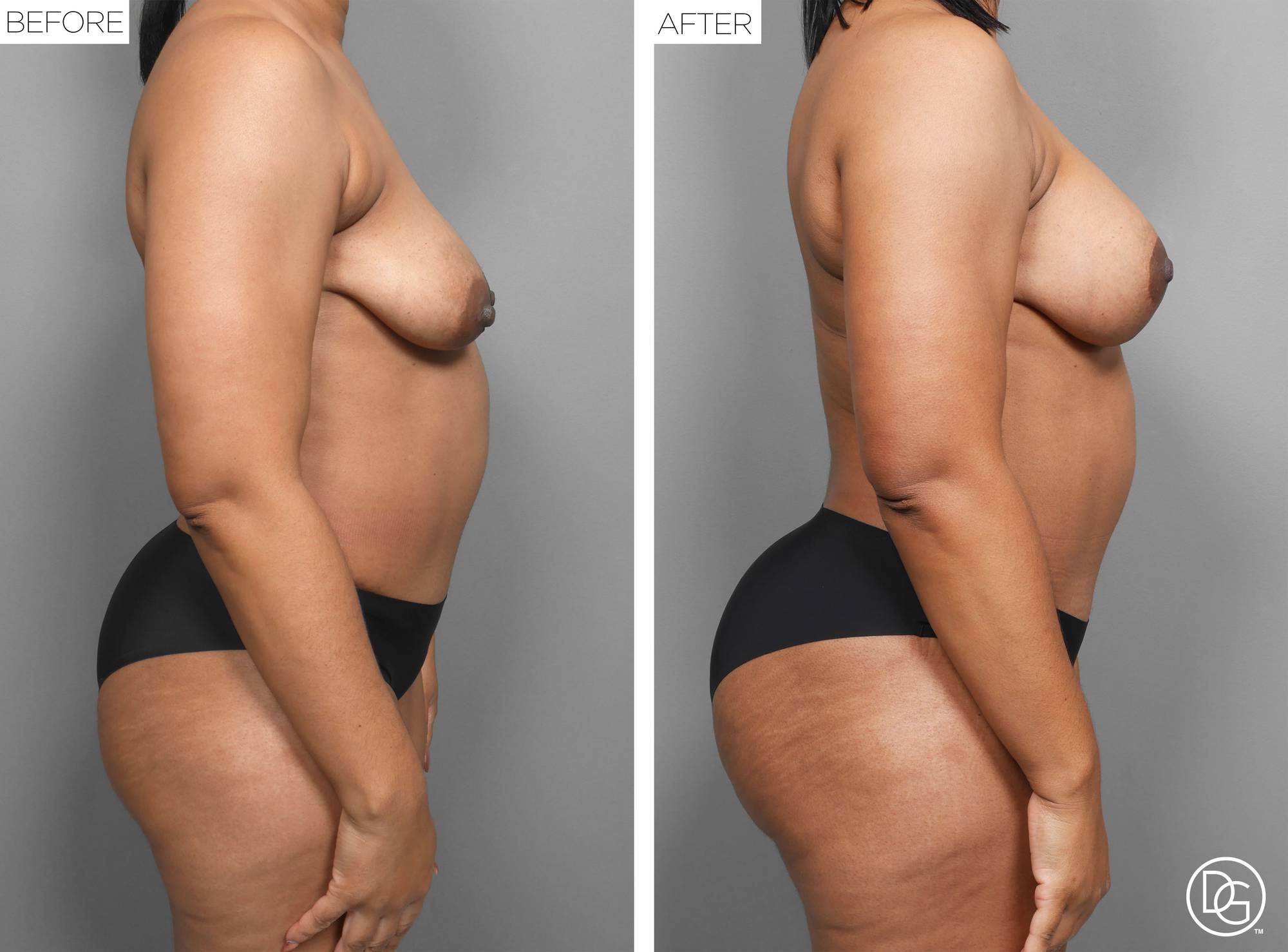 Liposuction Before & After Image