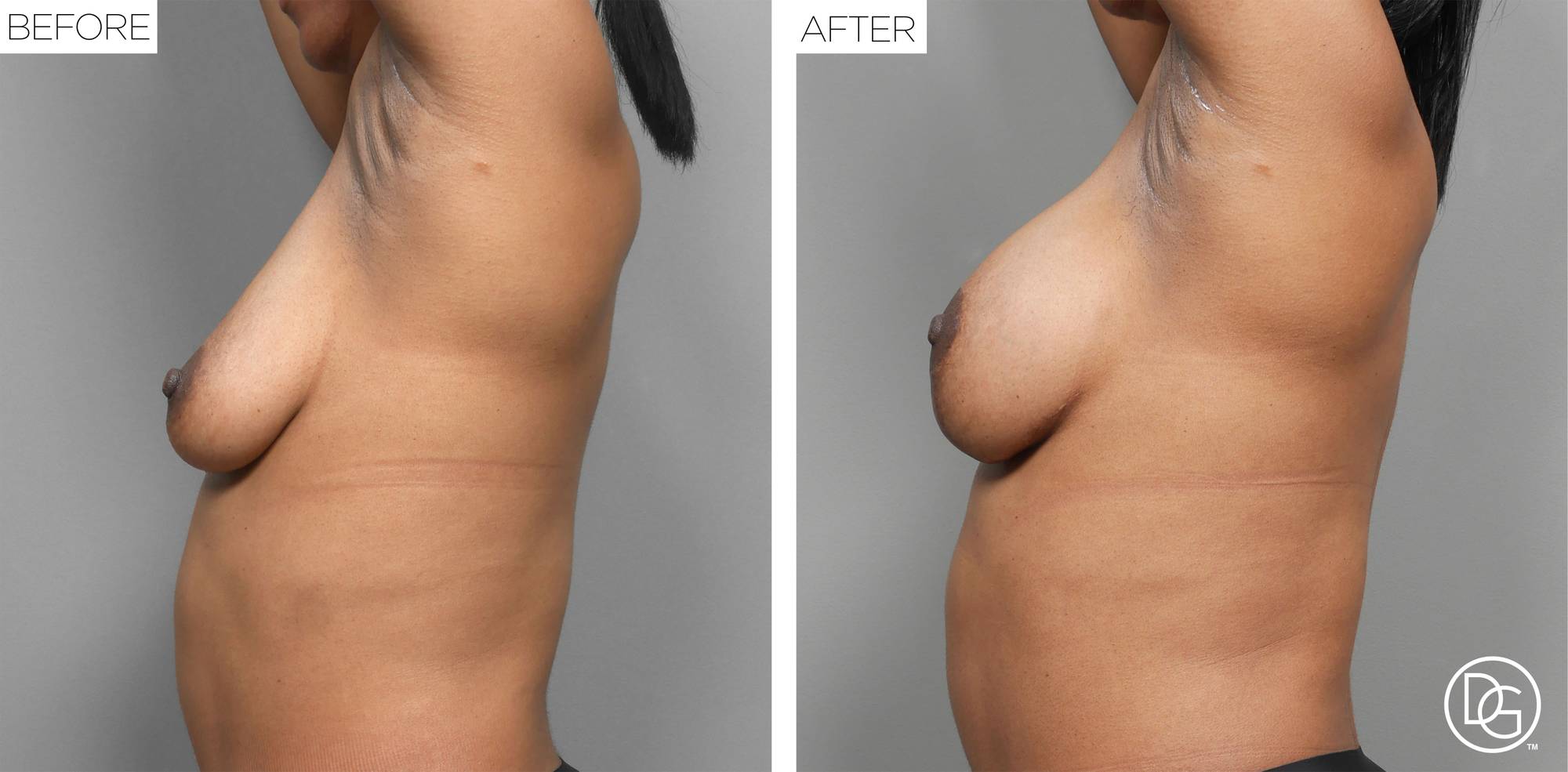 Breast Lift Before & After Image