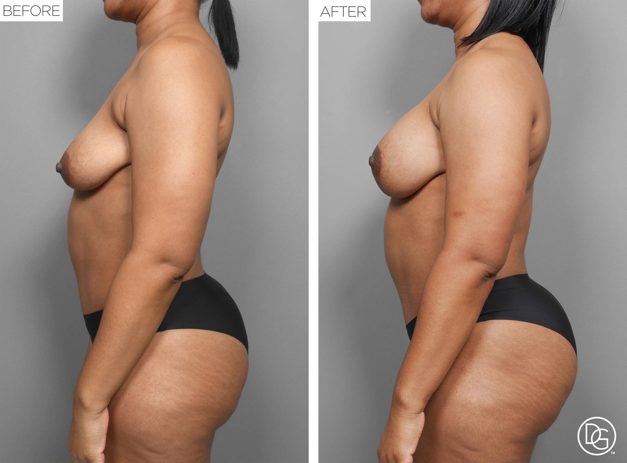 Liposuction Before & After Image