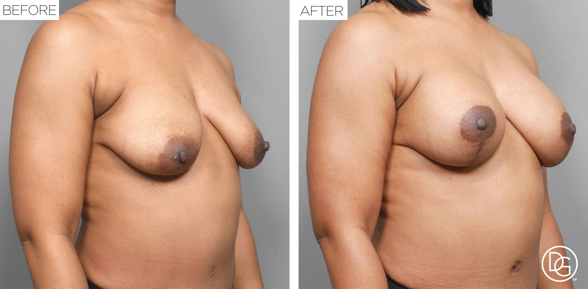 Breast Lift Before & After Image