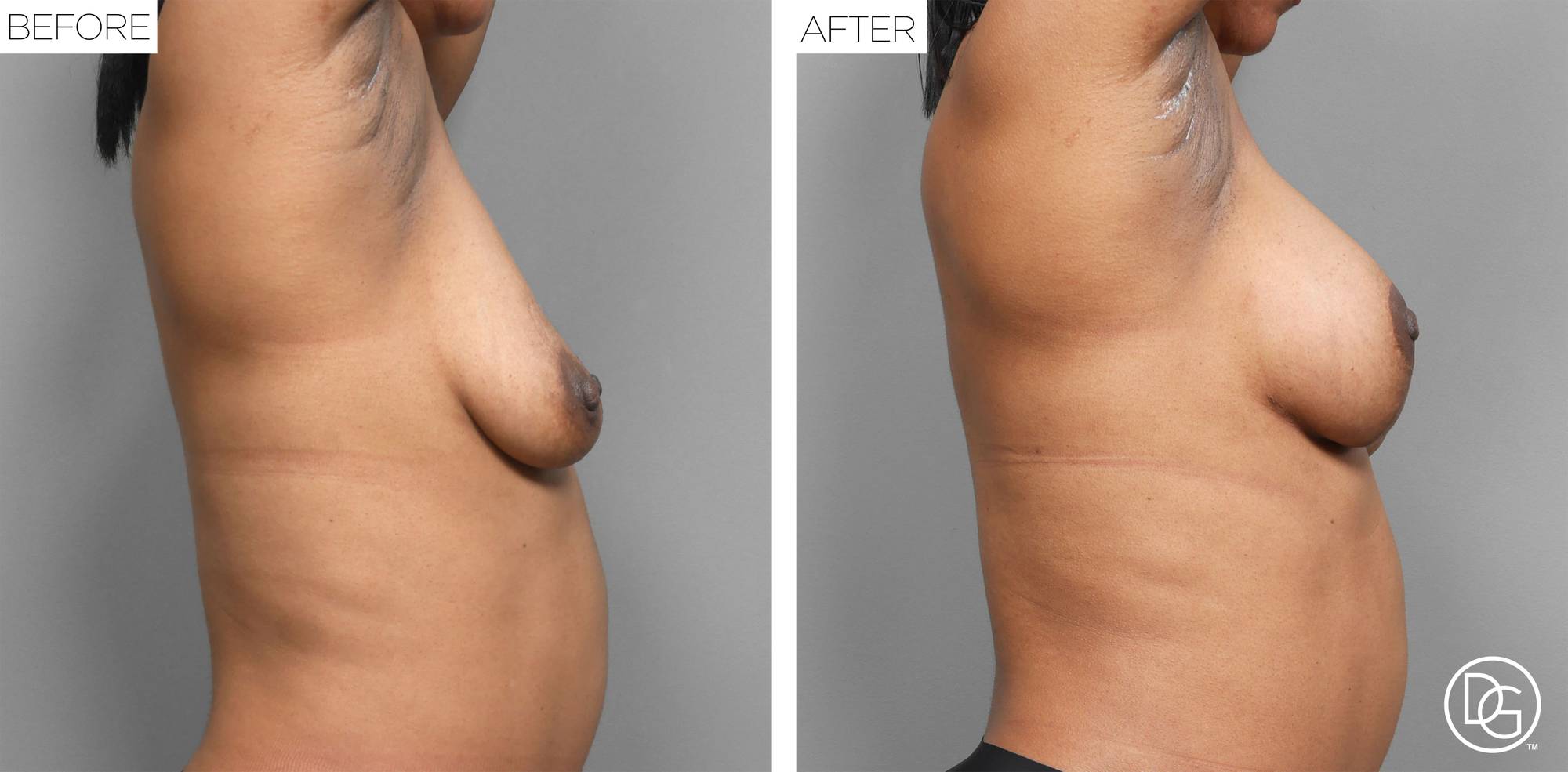 Breast Lift Before & After Image