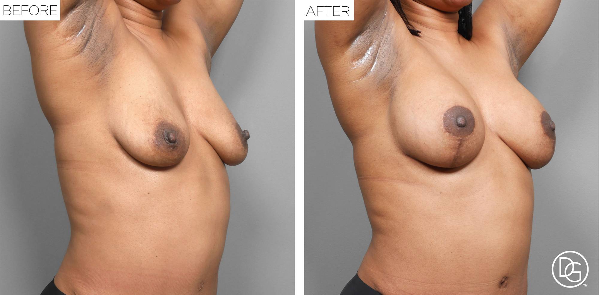Breast Lift Before & After Image