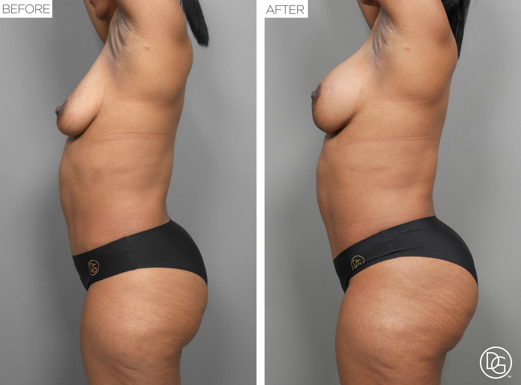 Liposuction Before & After Image