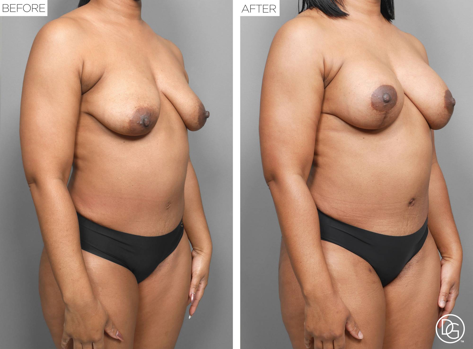 Liposuction Before & After Image
