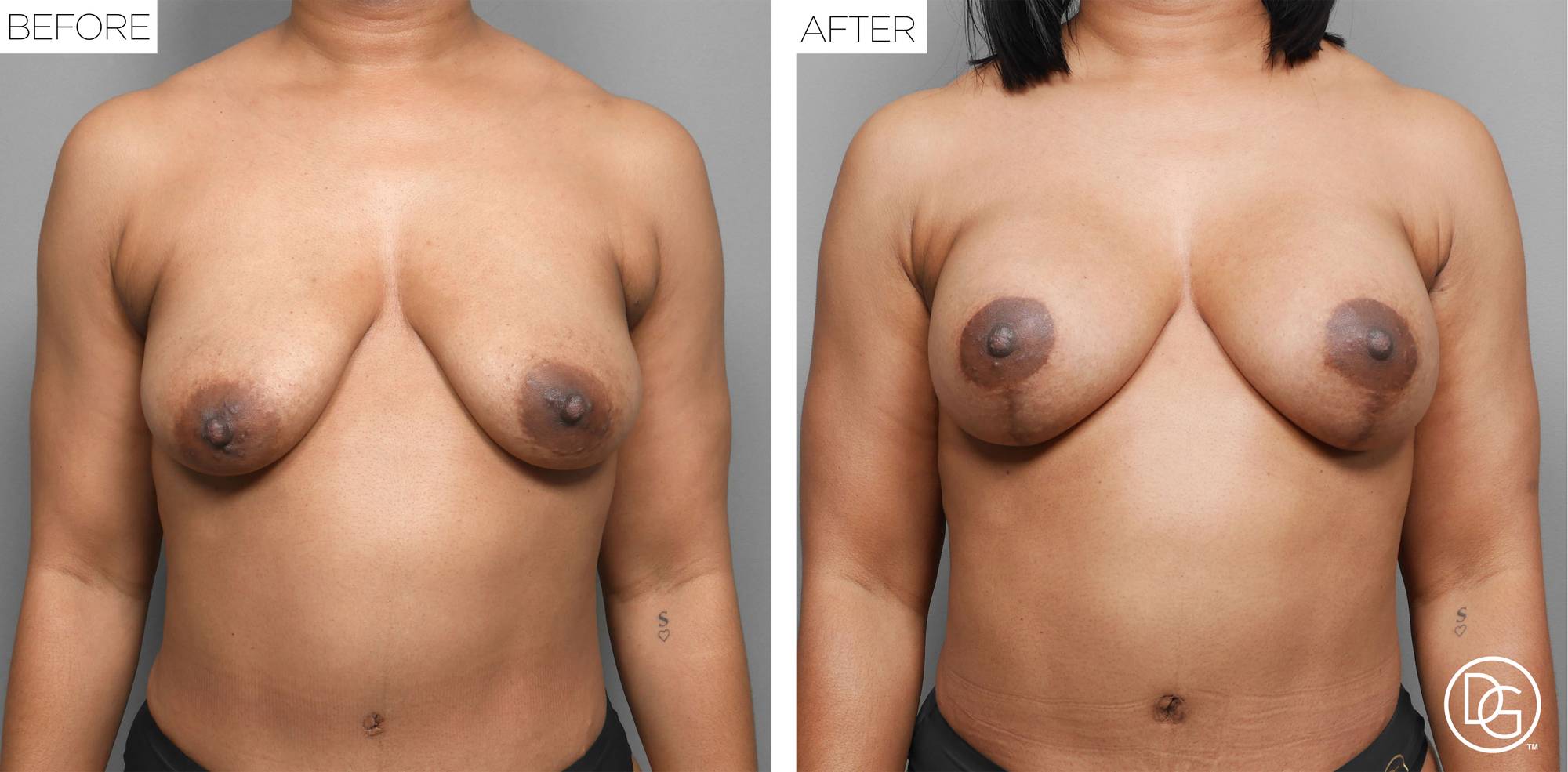 Breast Lift Before & After Image