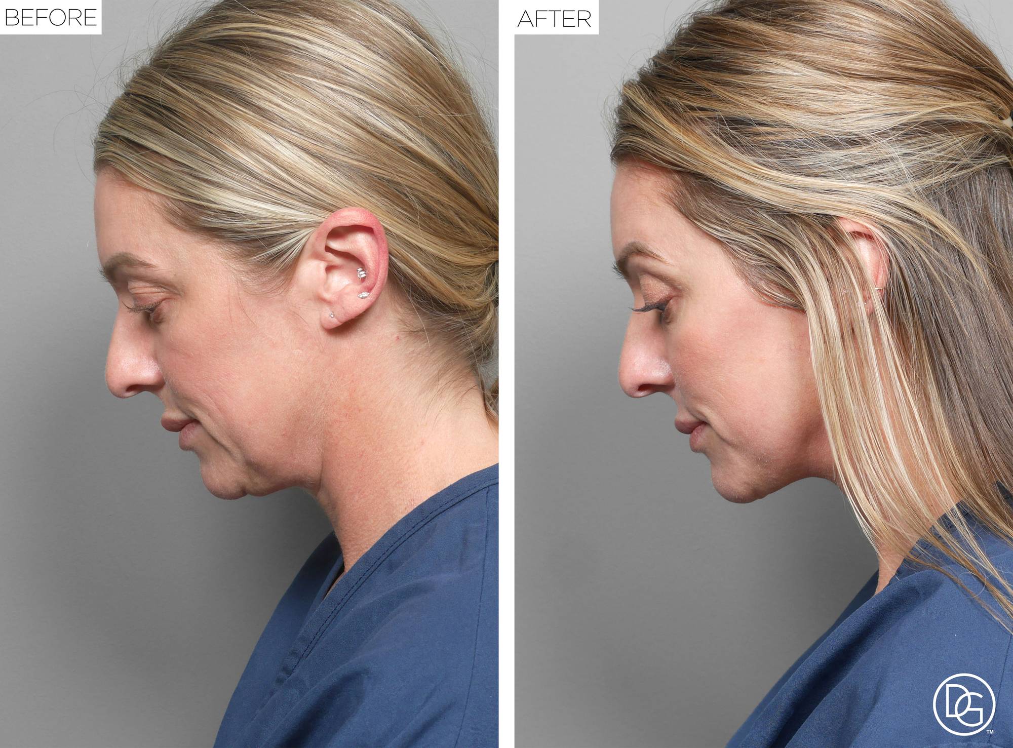 Facelift Before & After Image
