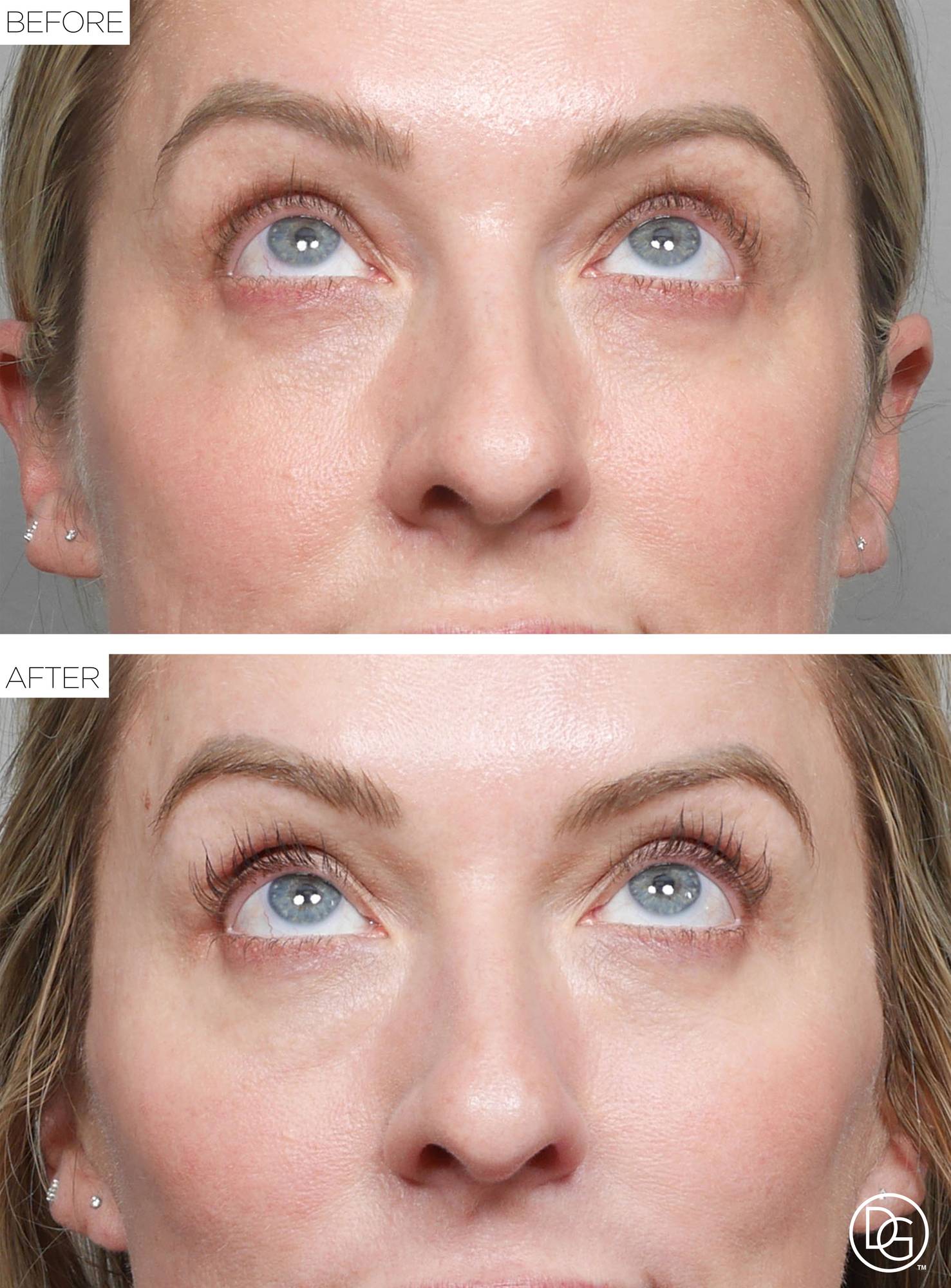 Blepharoplasty Before & After Image