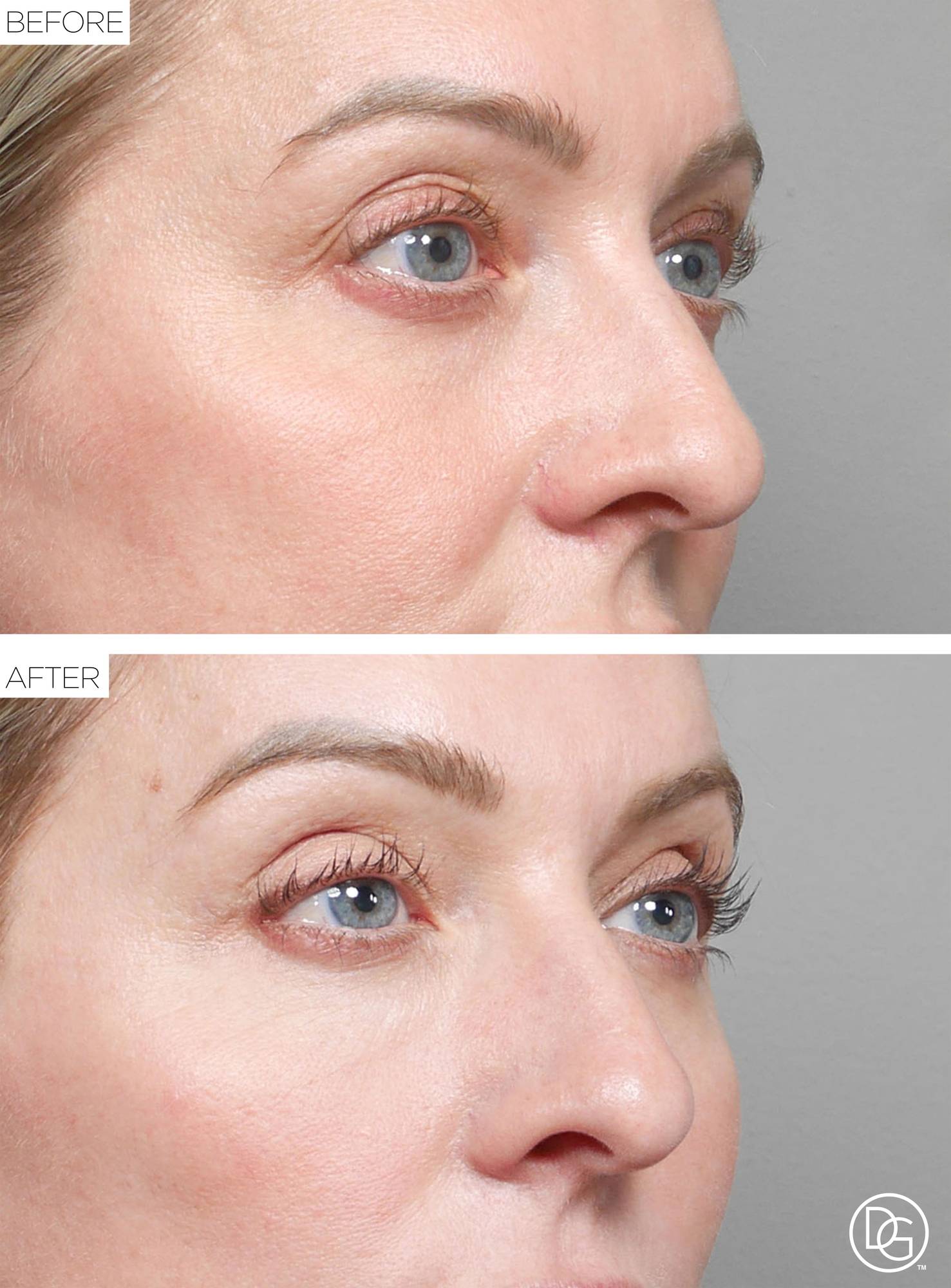 Blepharoplasty Before & After Image
