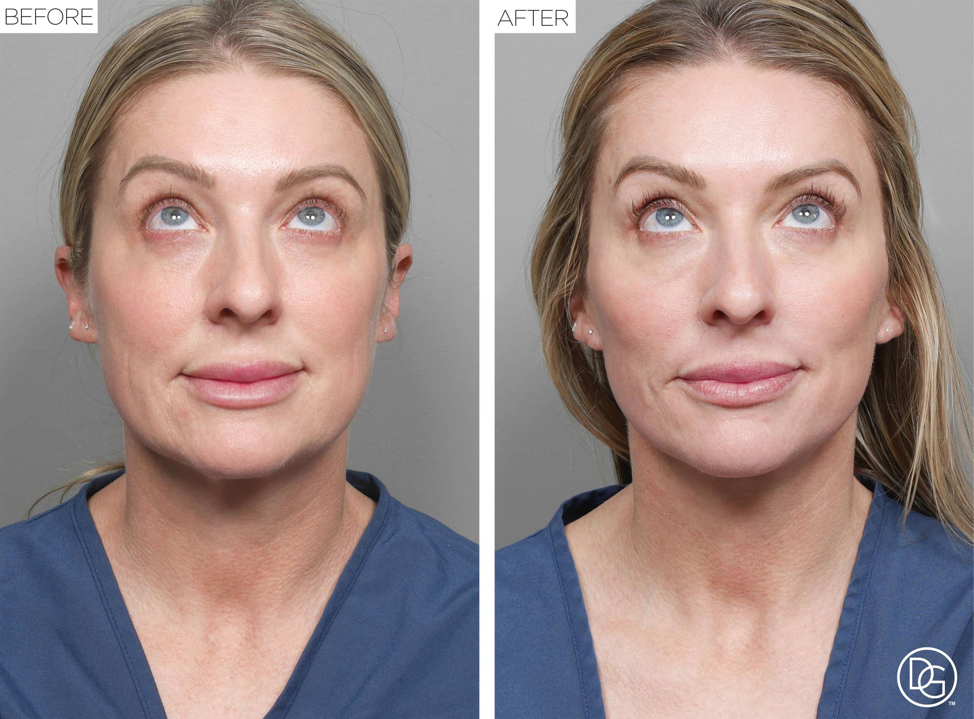 Facelift Before & After Image