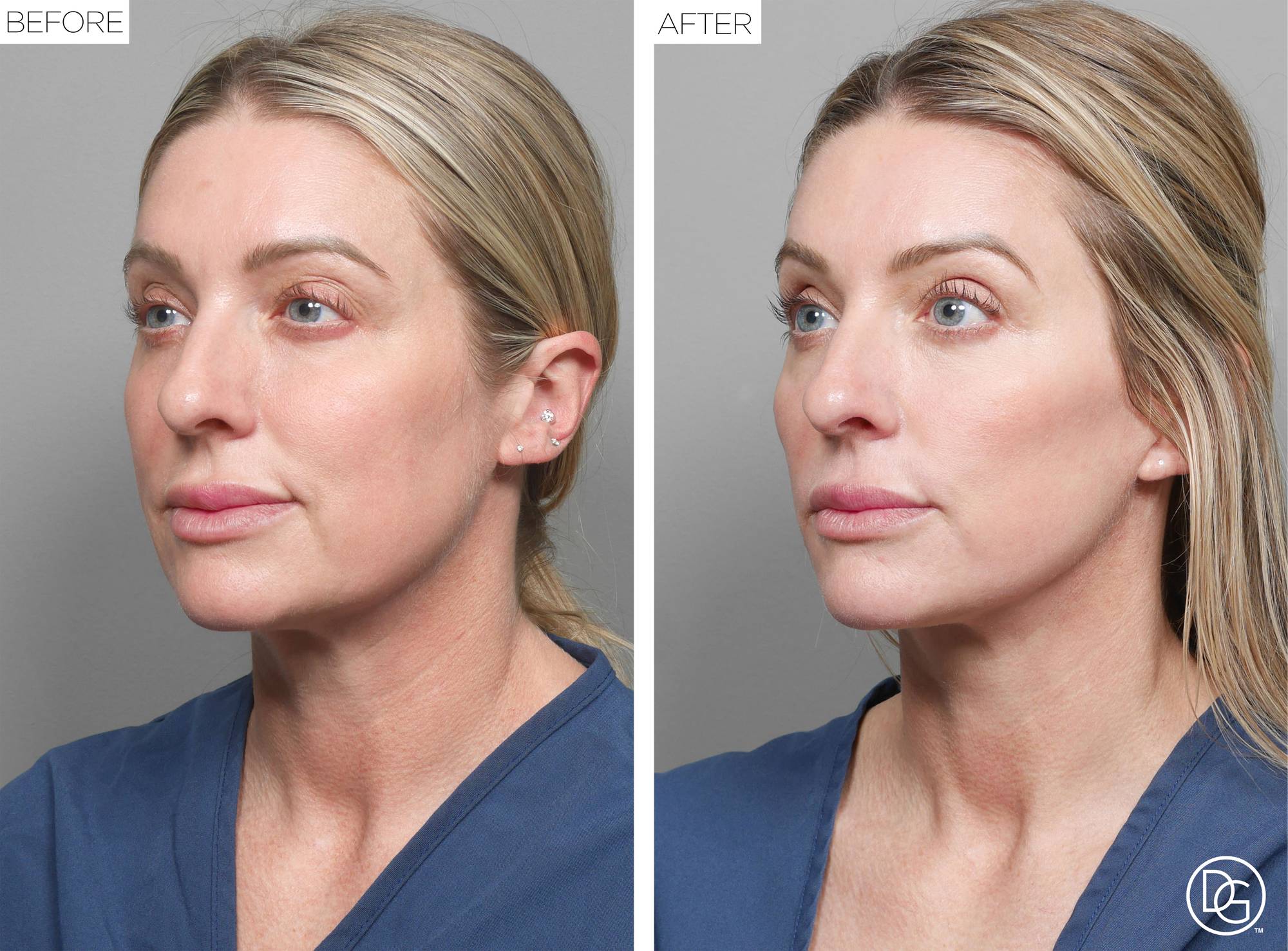 Facelift Before & After Image