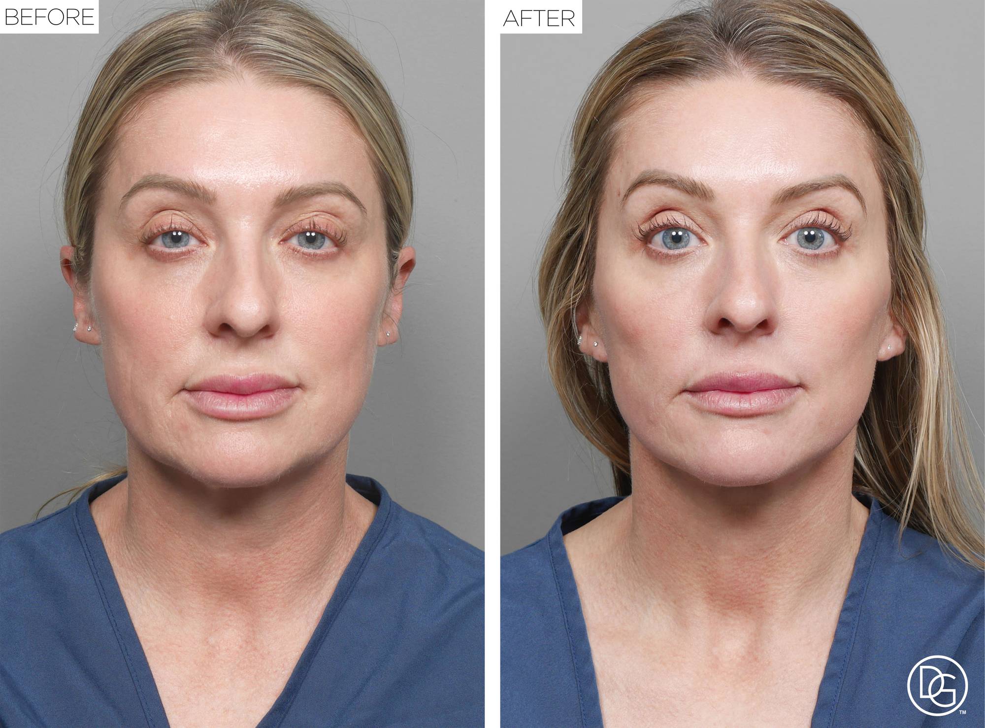 Facelift Before & After Image
