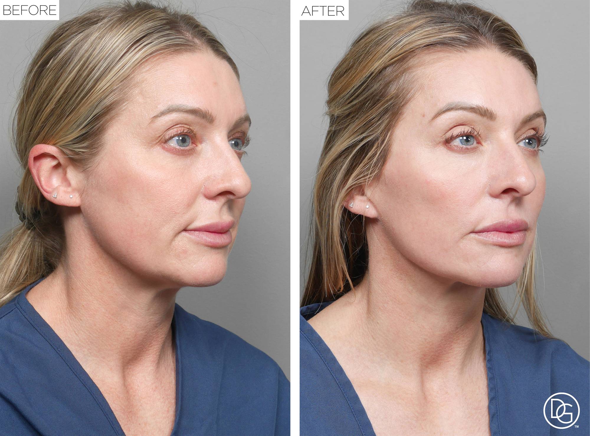 Facelift Before & After Image