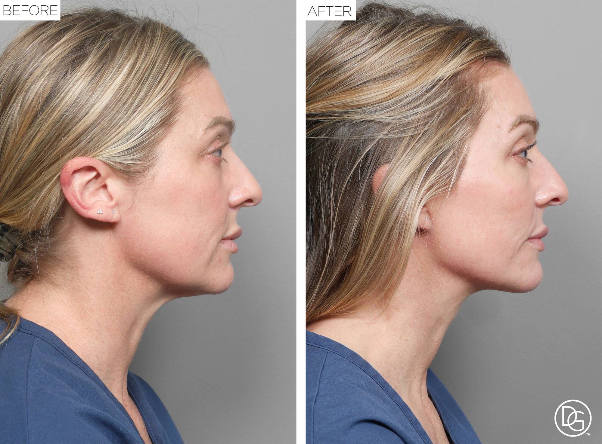 Facelift Before & After Image