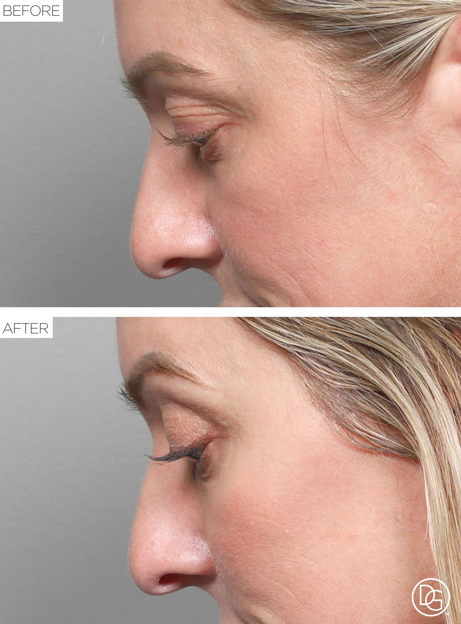 Blepharoplasty Before & After Image
