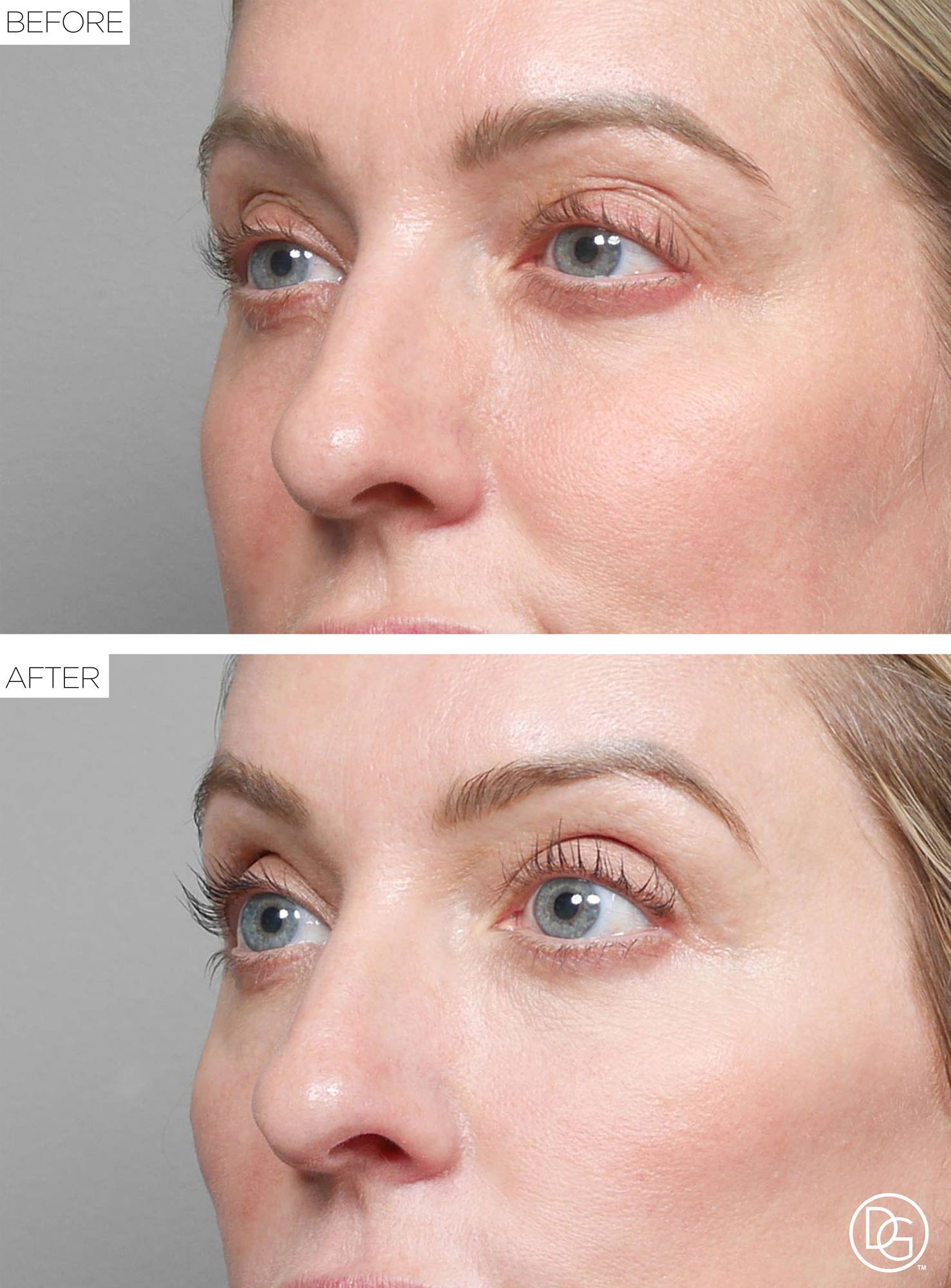 Blepharoplasty Before & After Image