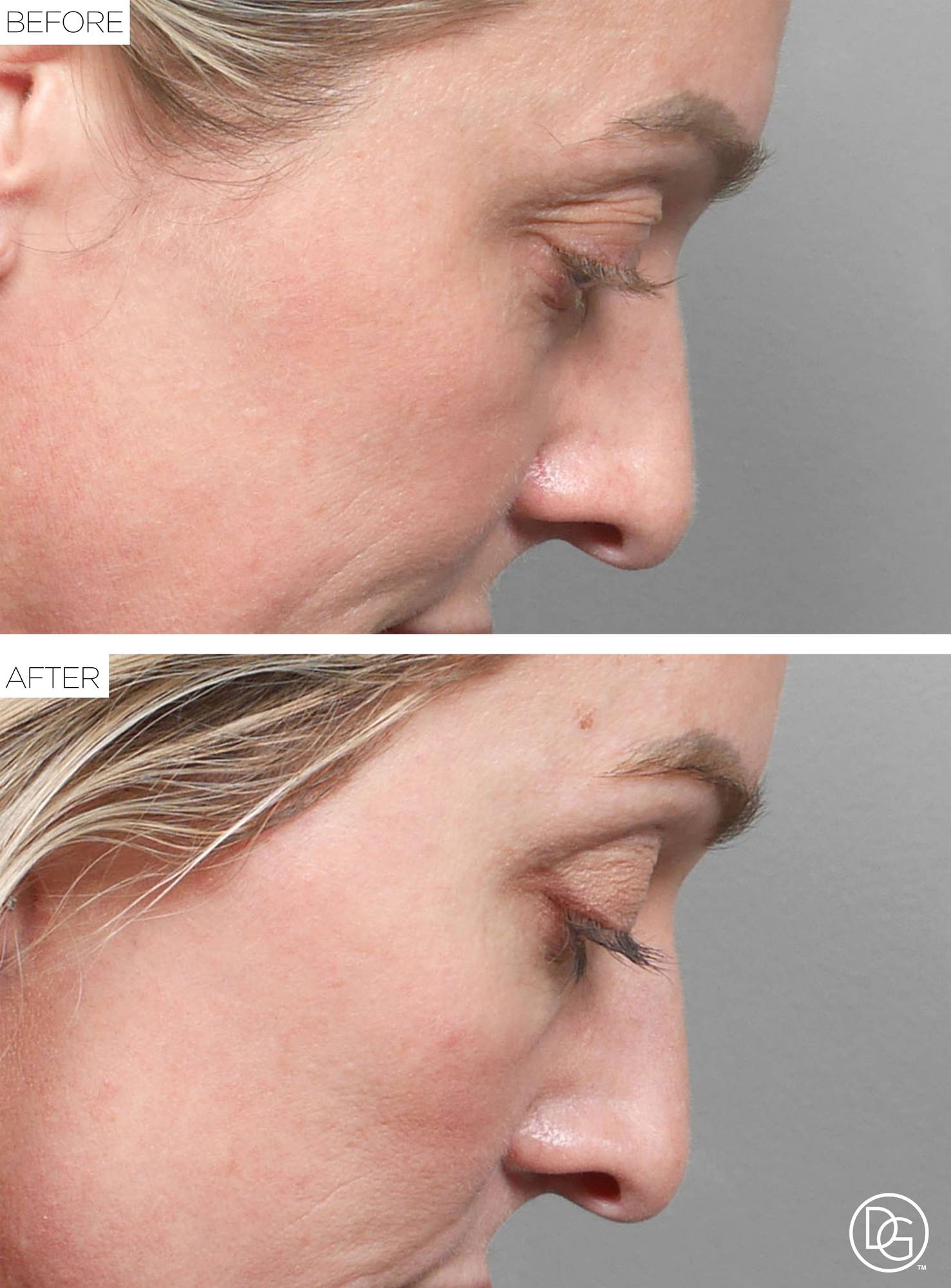 Blepharoplasty Before & After Image