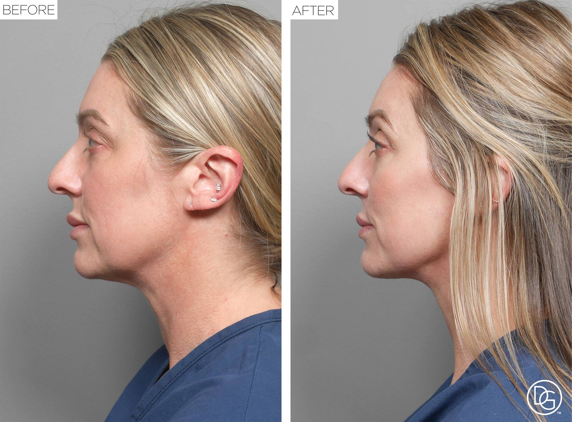 Facelift Before & After Image