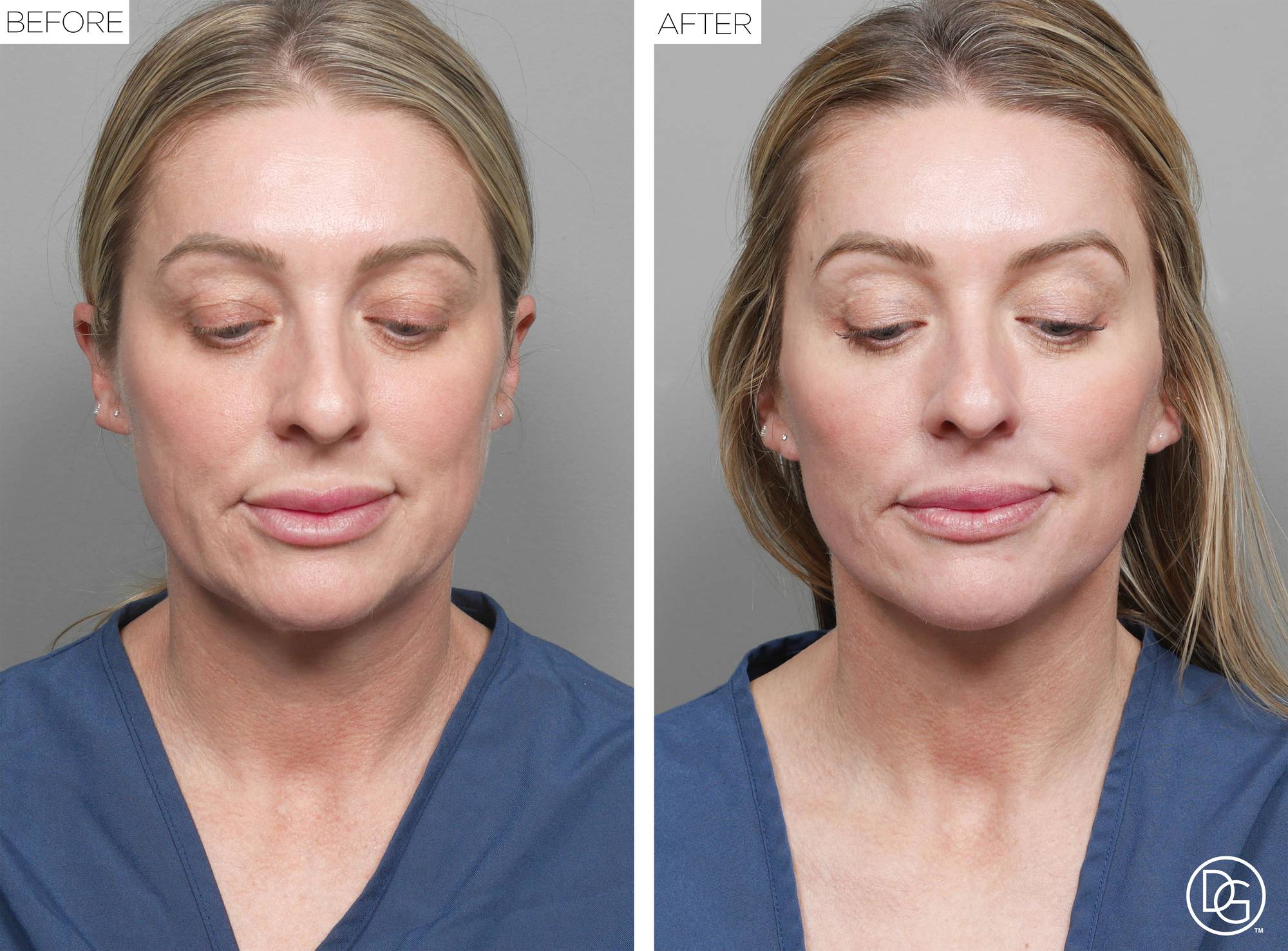 Facelift Before & After Image