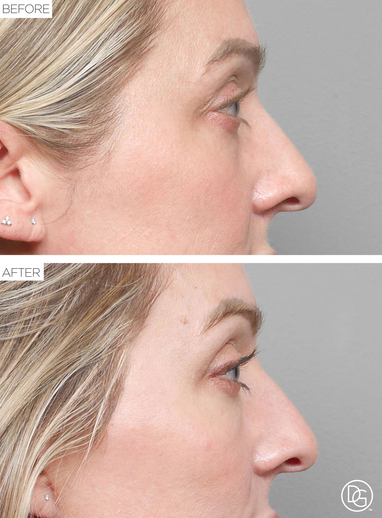 Blepharoplasty Before & After Image