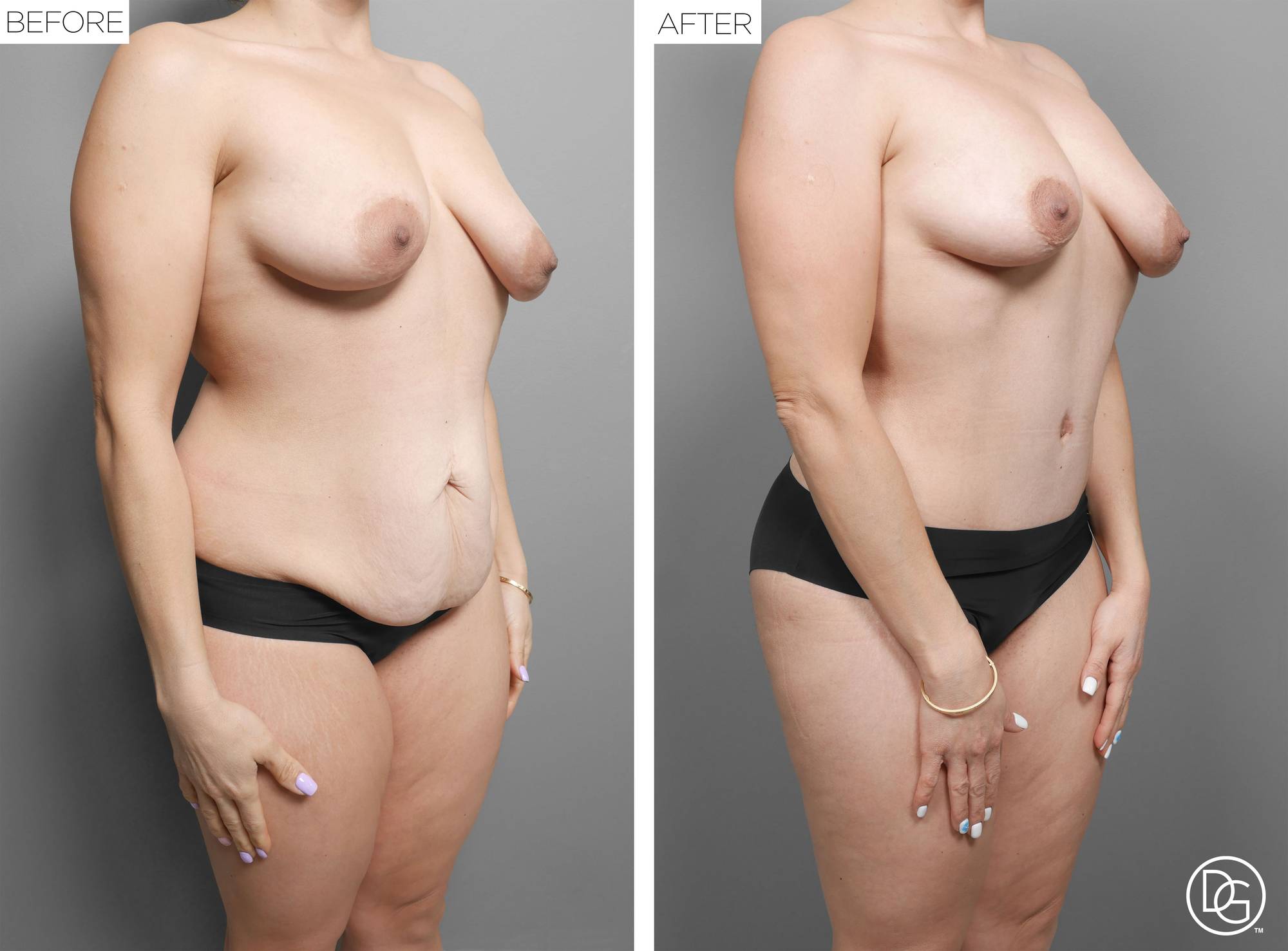  Tummy Tuck Before & After Image
