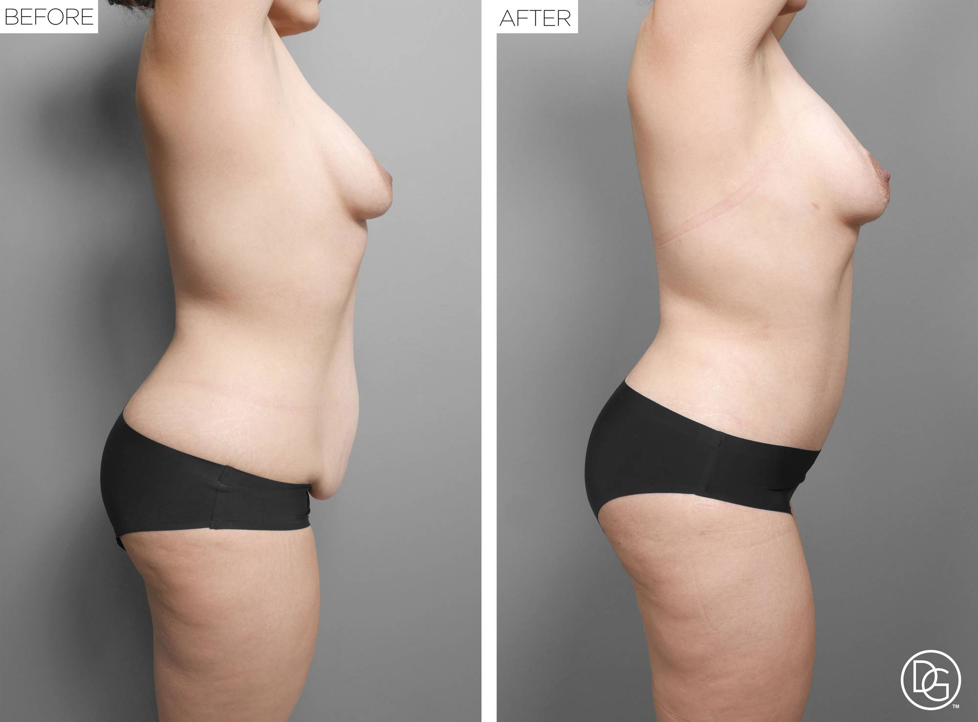  Tummy Tuck Before & After Image