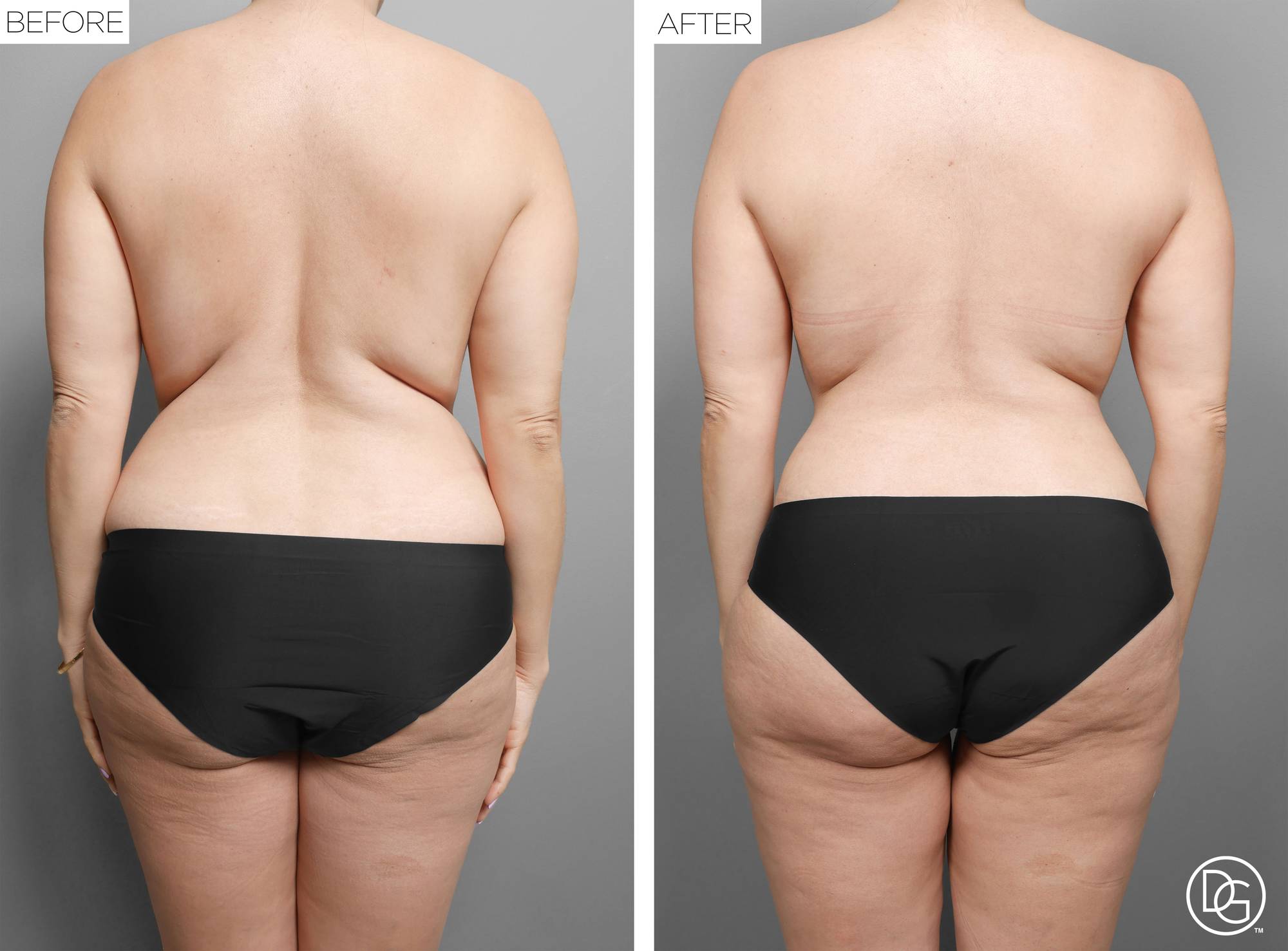  Tummy Tuck Before & After Image