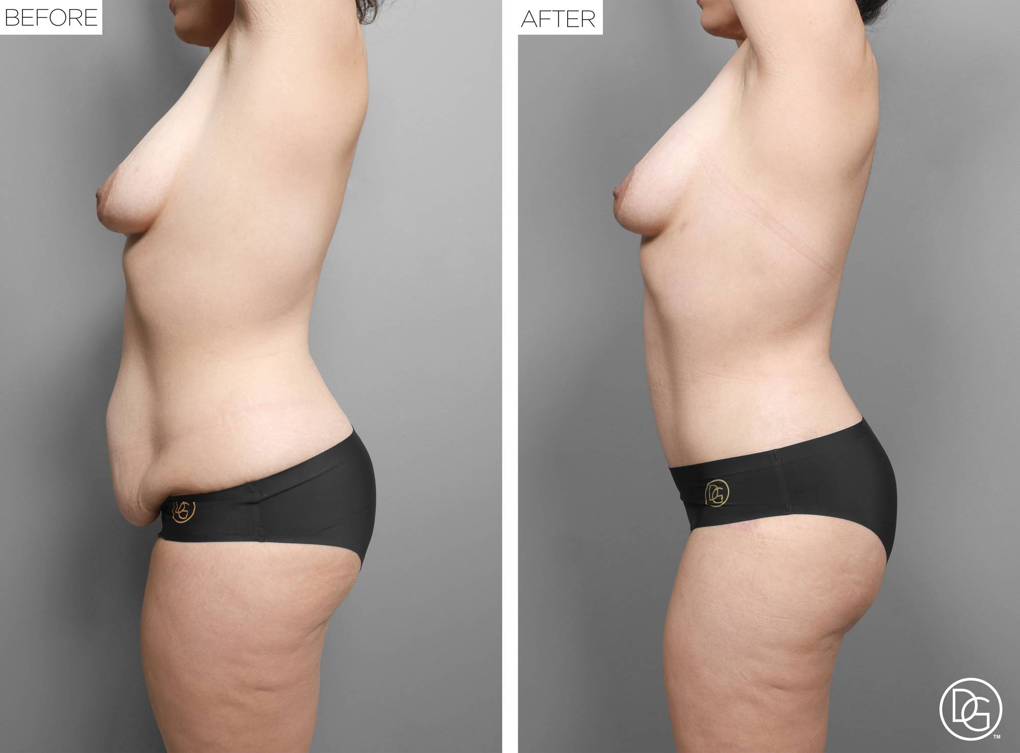  Tummy Tuck Before & After Image