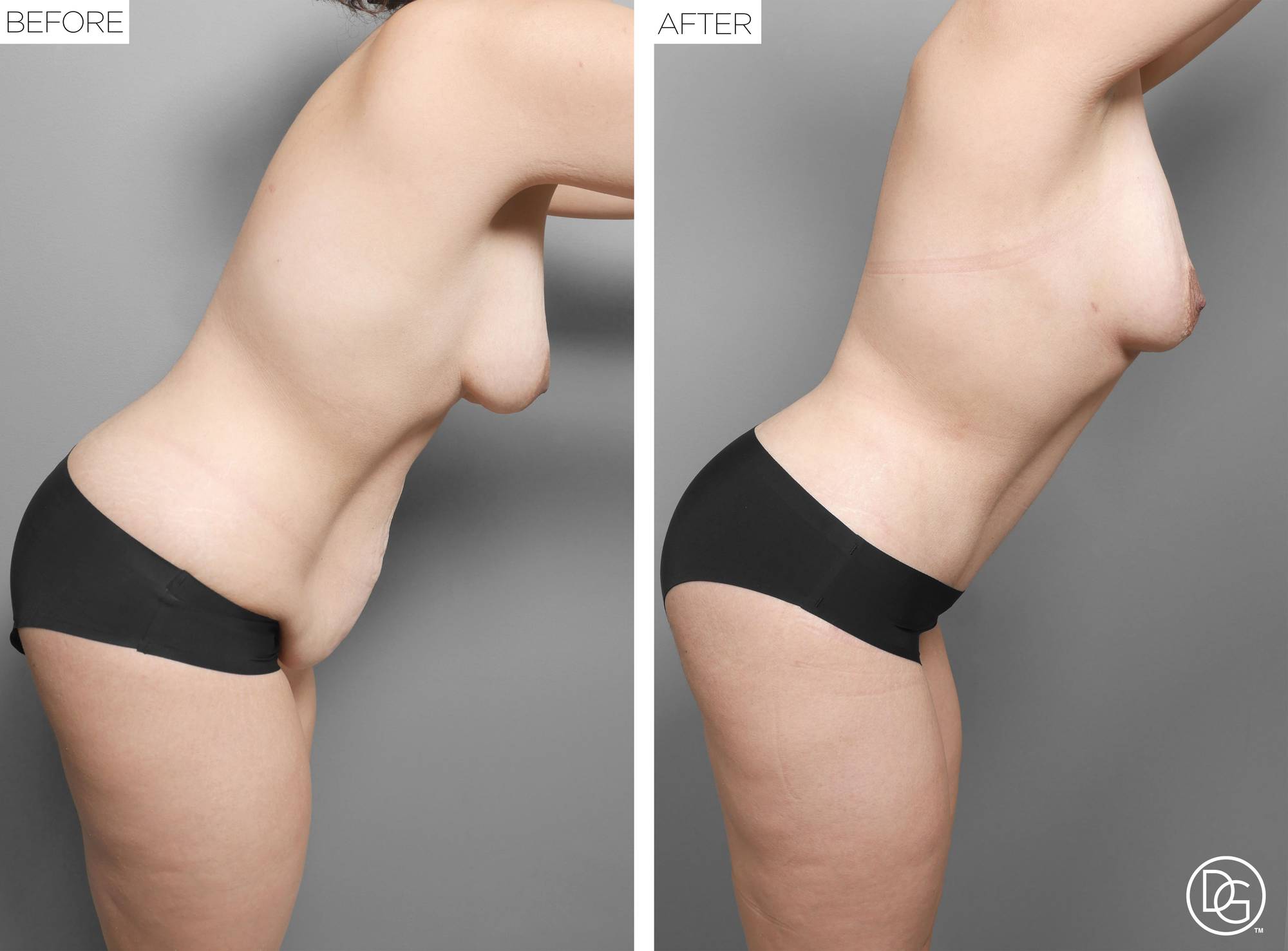  Tummy Tuck Before & After Image