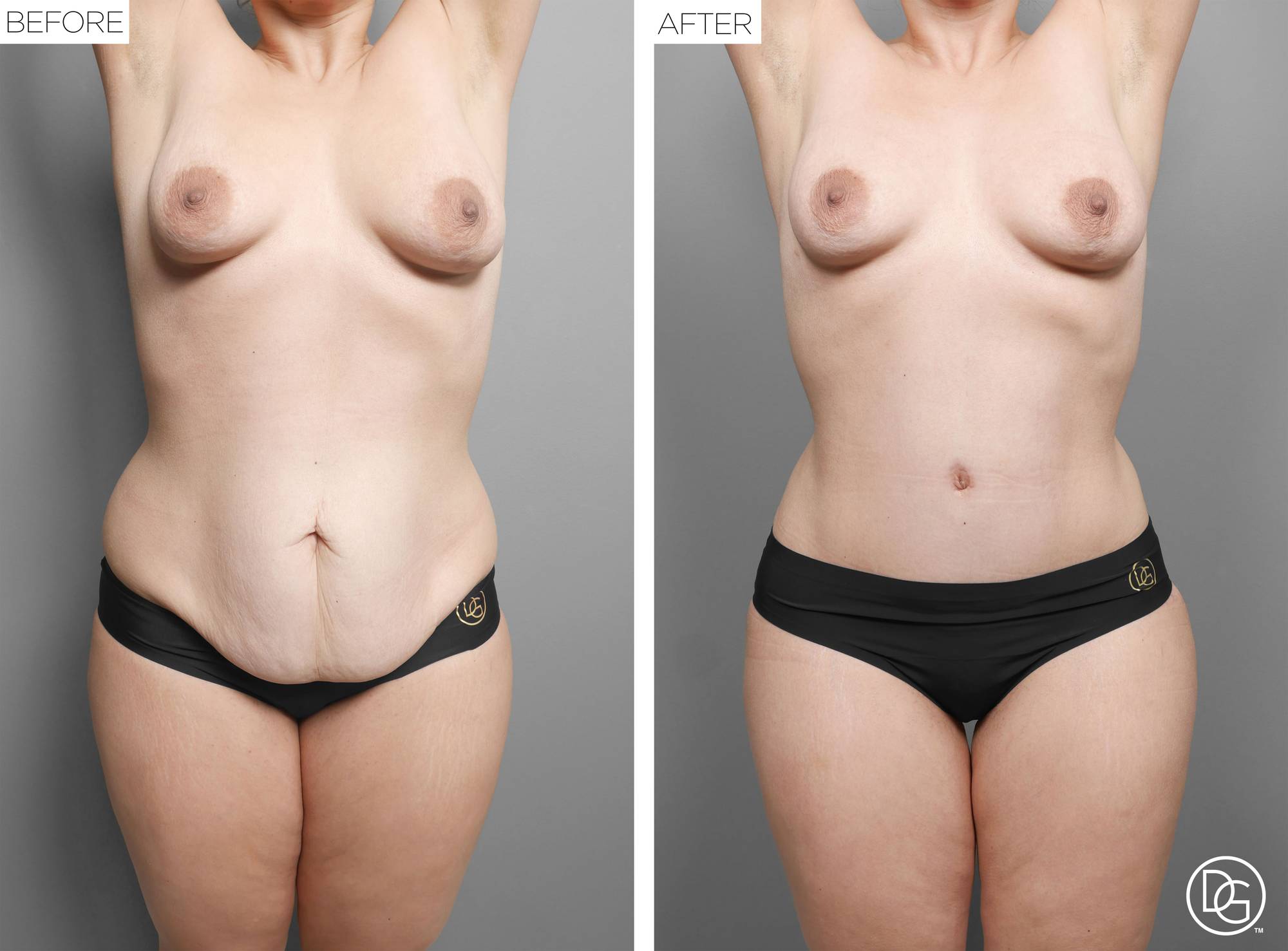  Tummy Tuck Before & After Image