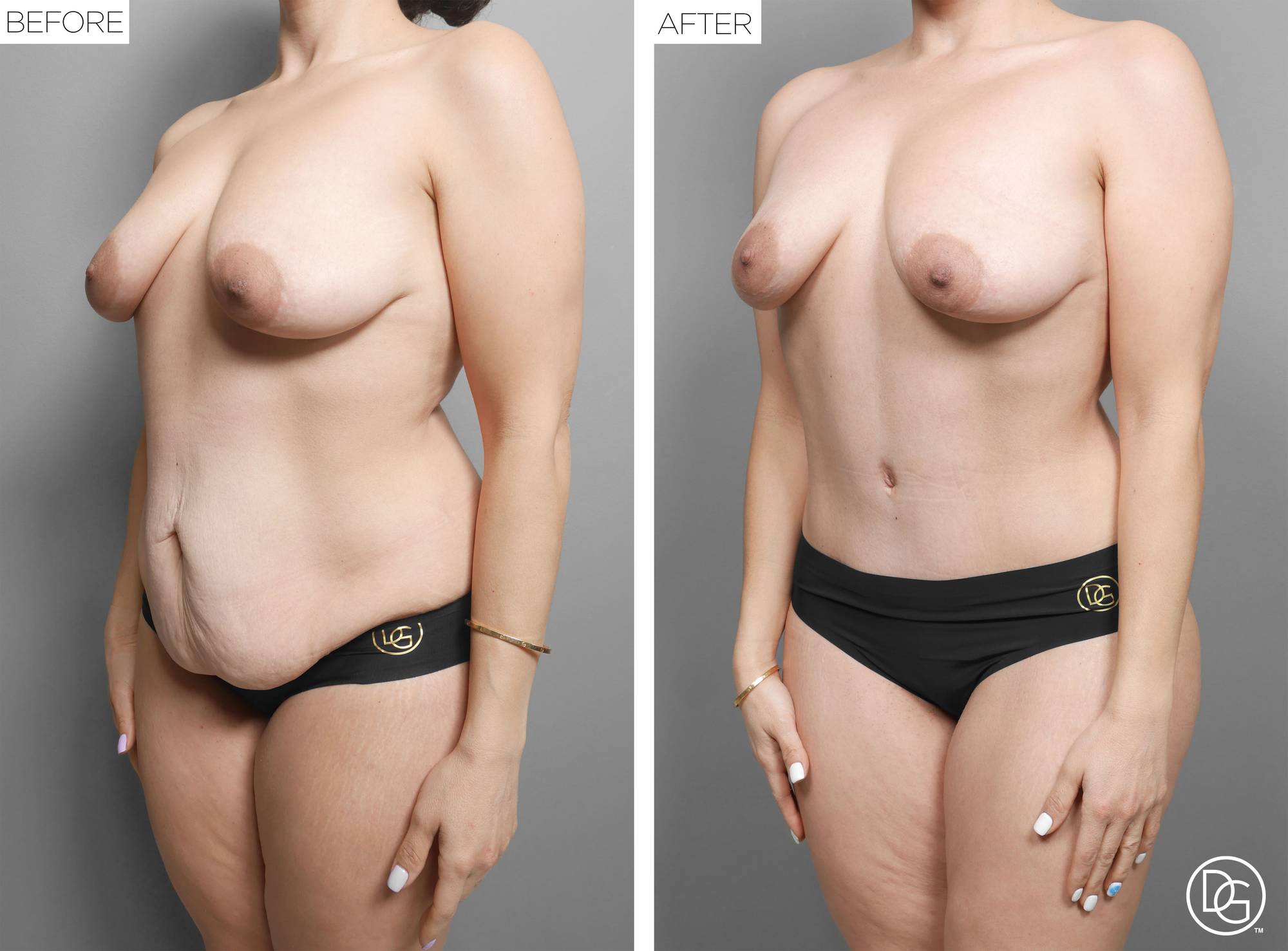  Tummy Tuck Before & After Image