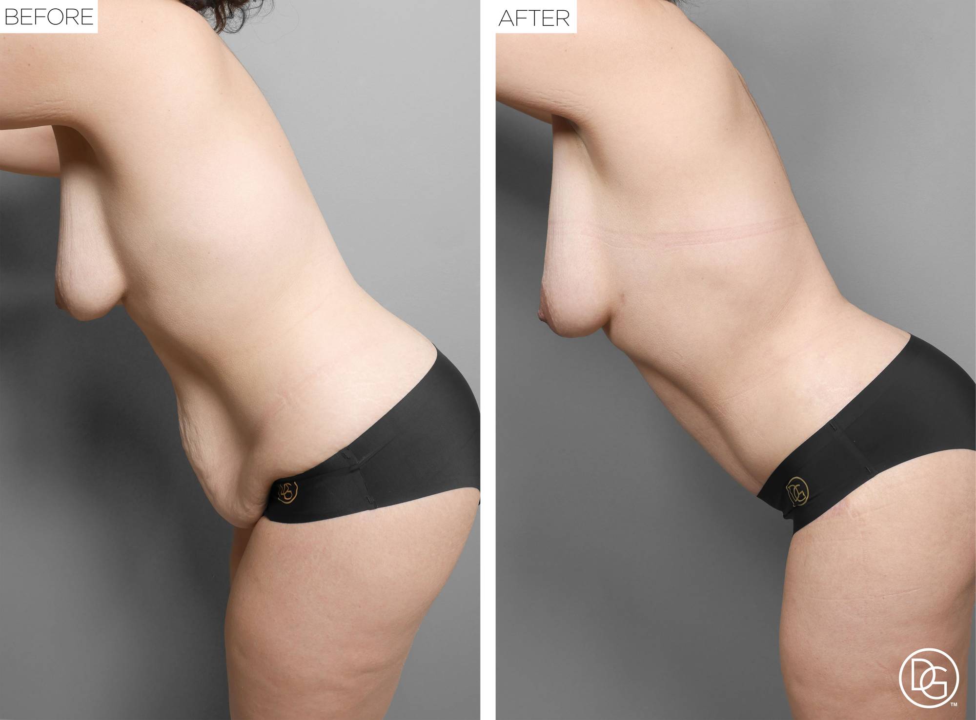  Tummy Tuck Before & After Image