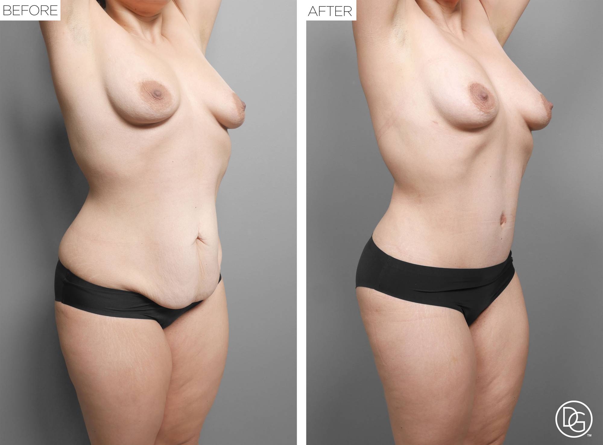  Tummy Tuck Before & After Image