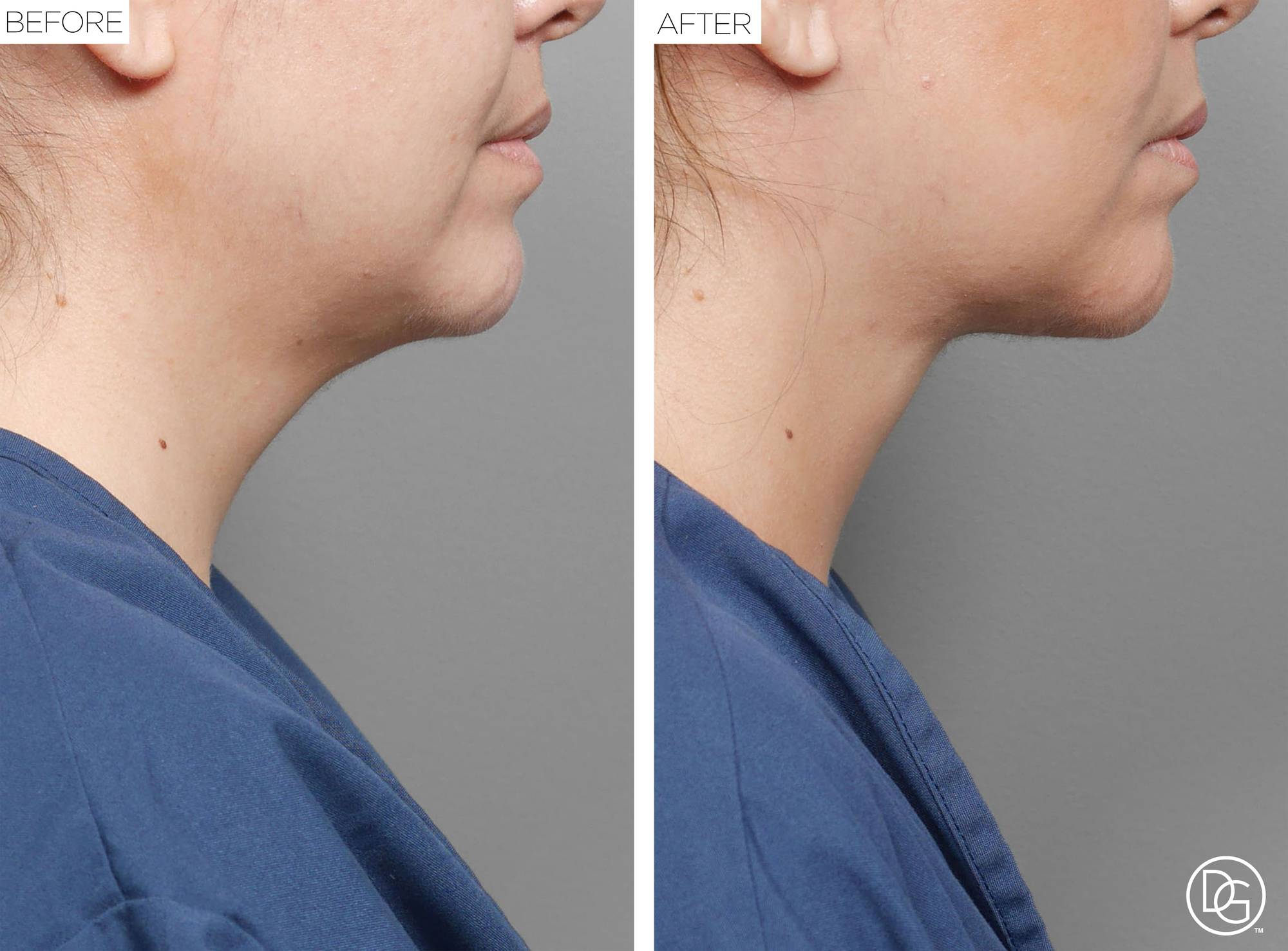 Weekend Lift Before & After Image