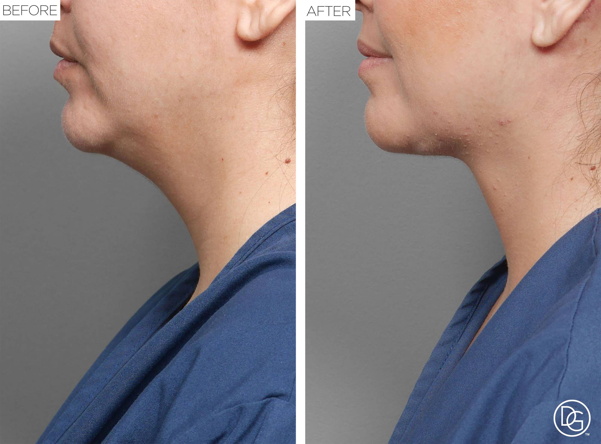 Weekend Lift Before & After Image