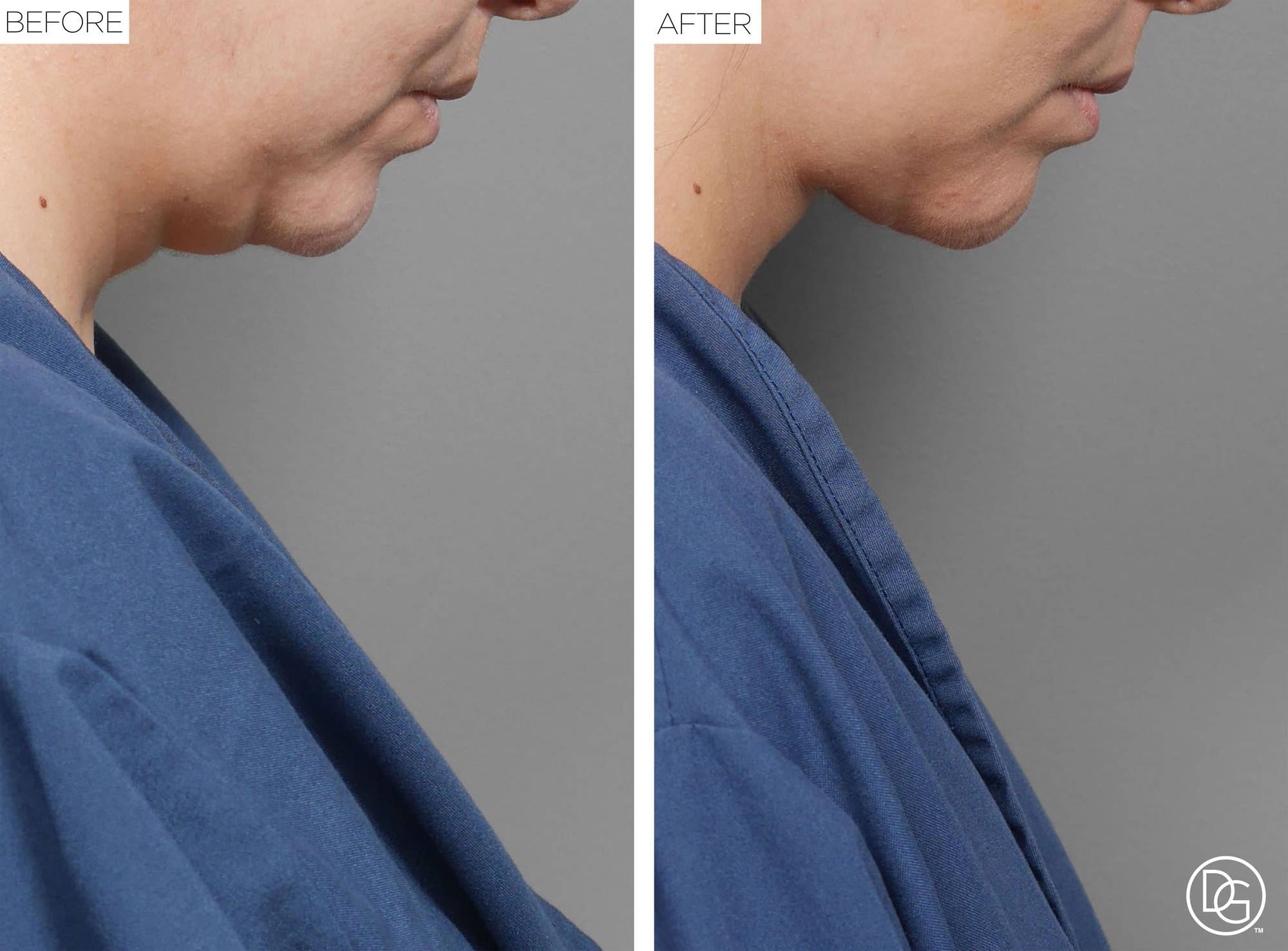 Weekend Lift Before & After Image