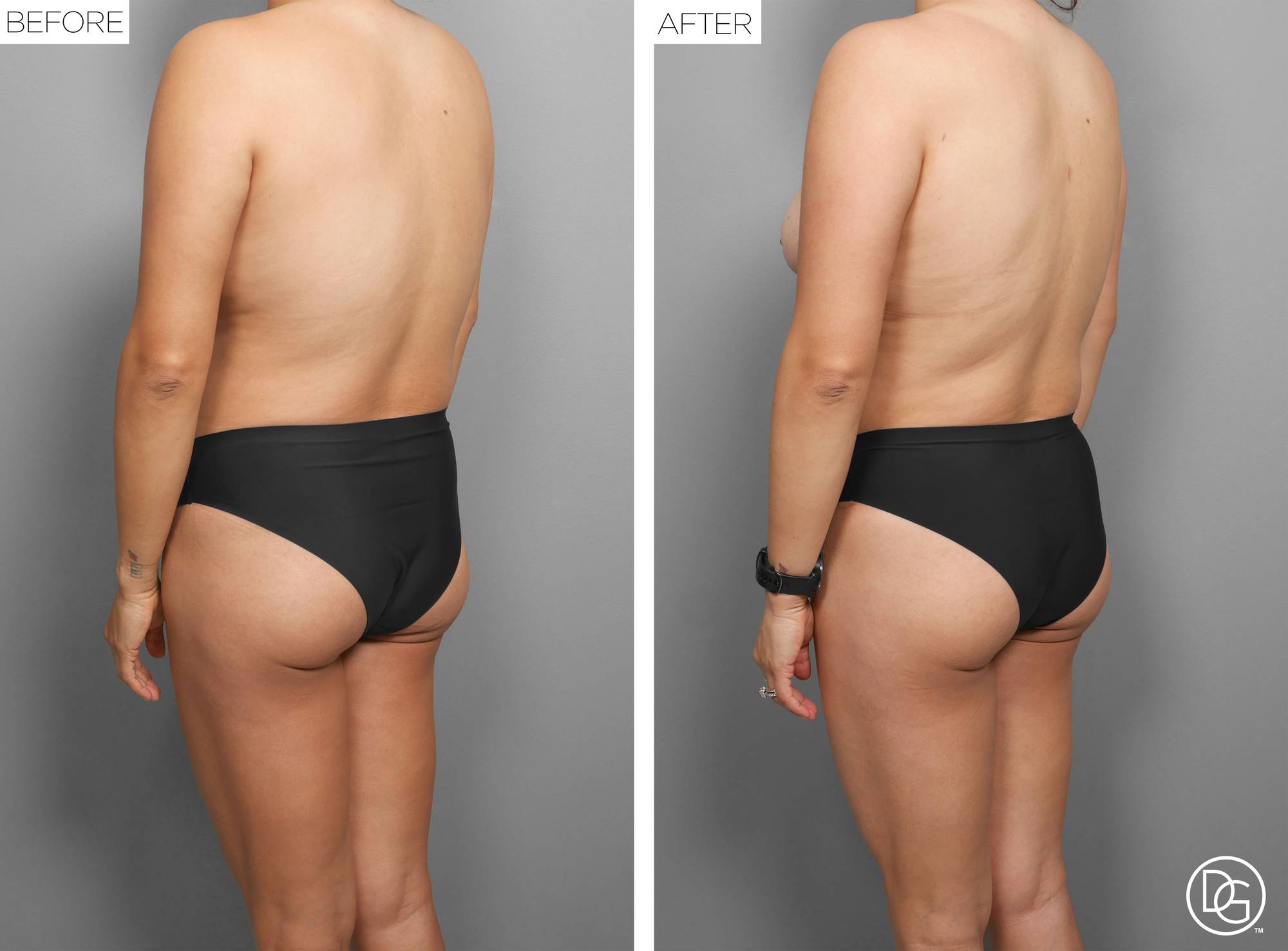Liposuction Before & After Image
