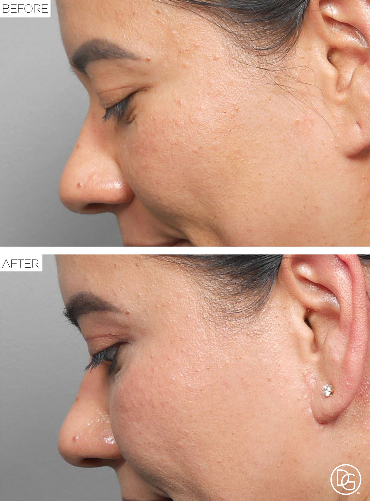 Blepharoplasty Before & After Image