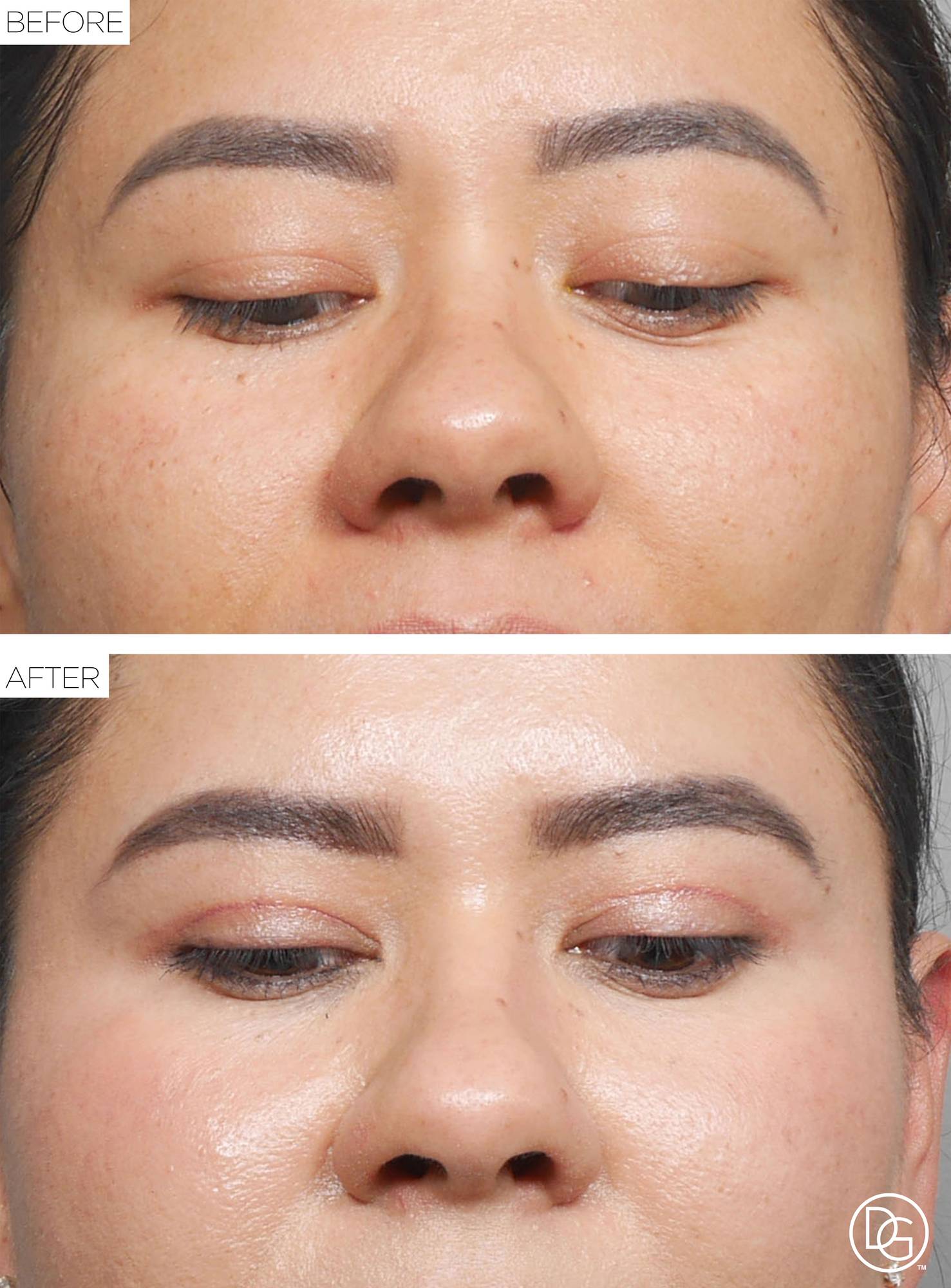 Blepharoplasty Before & After Image