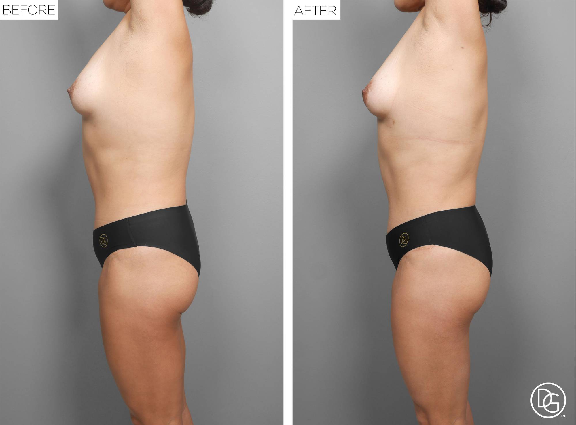 Liposuction Before & After Image
