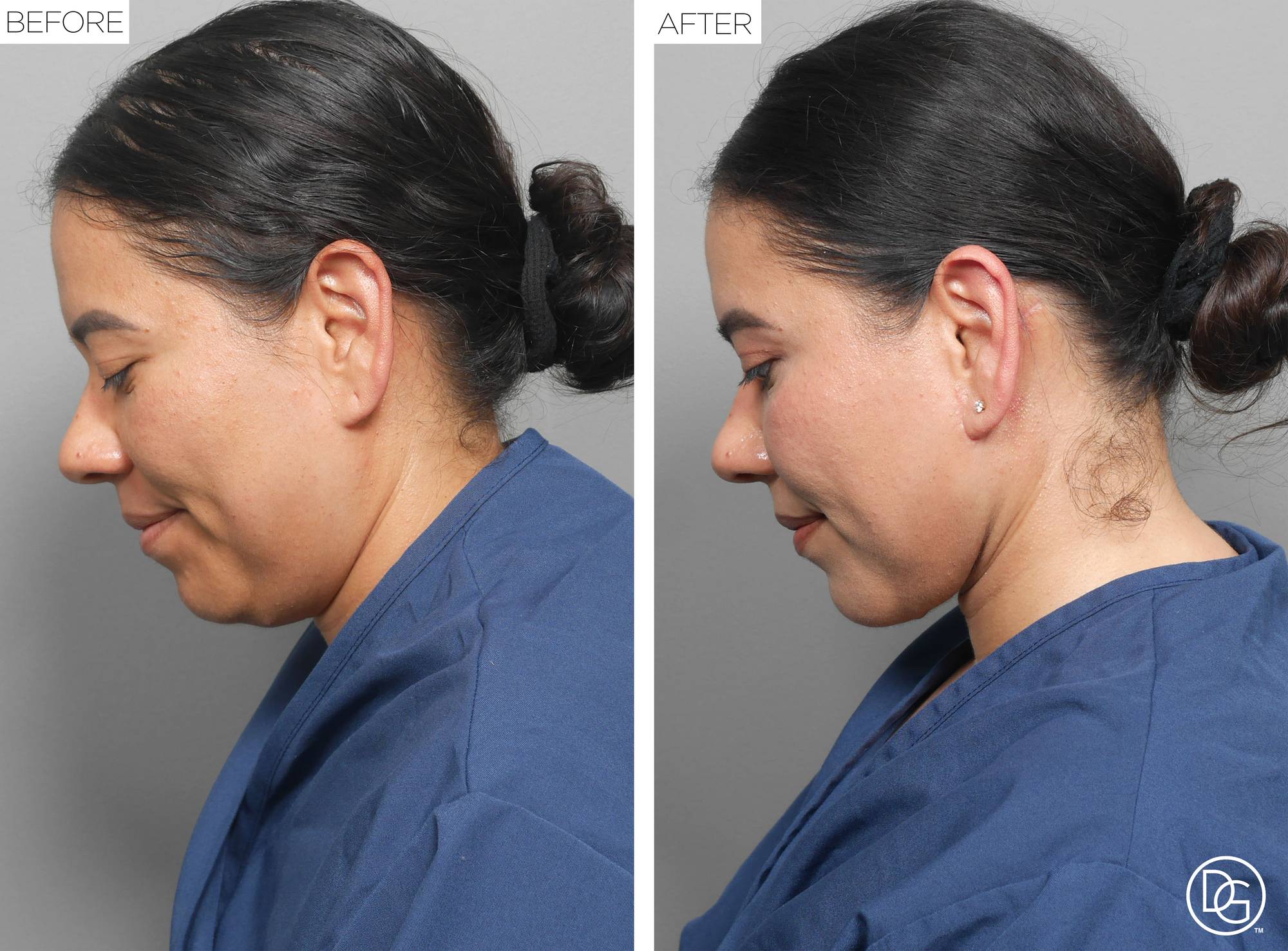 Weekend Lift Before & After Image