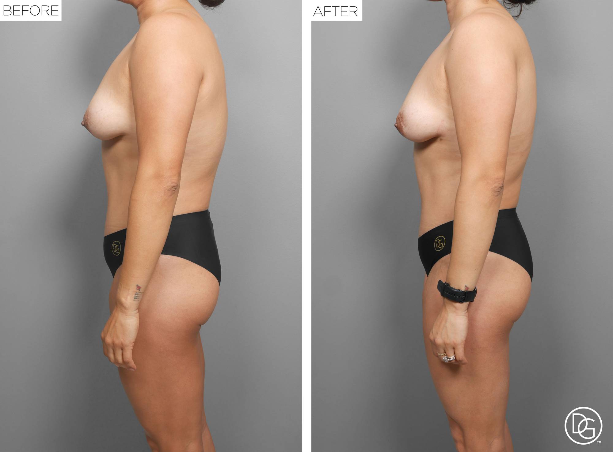 Liposuction Before & After Image
