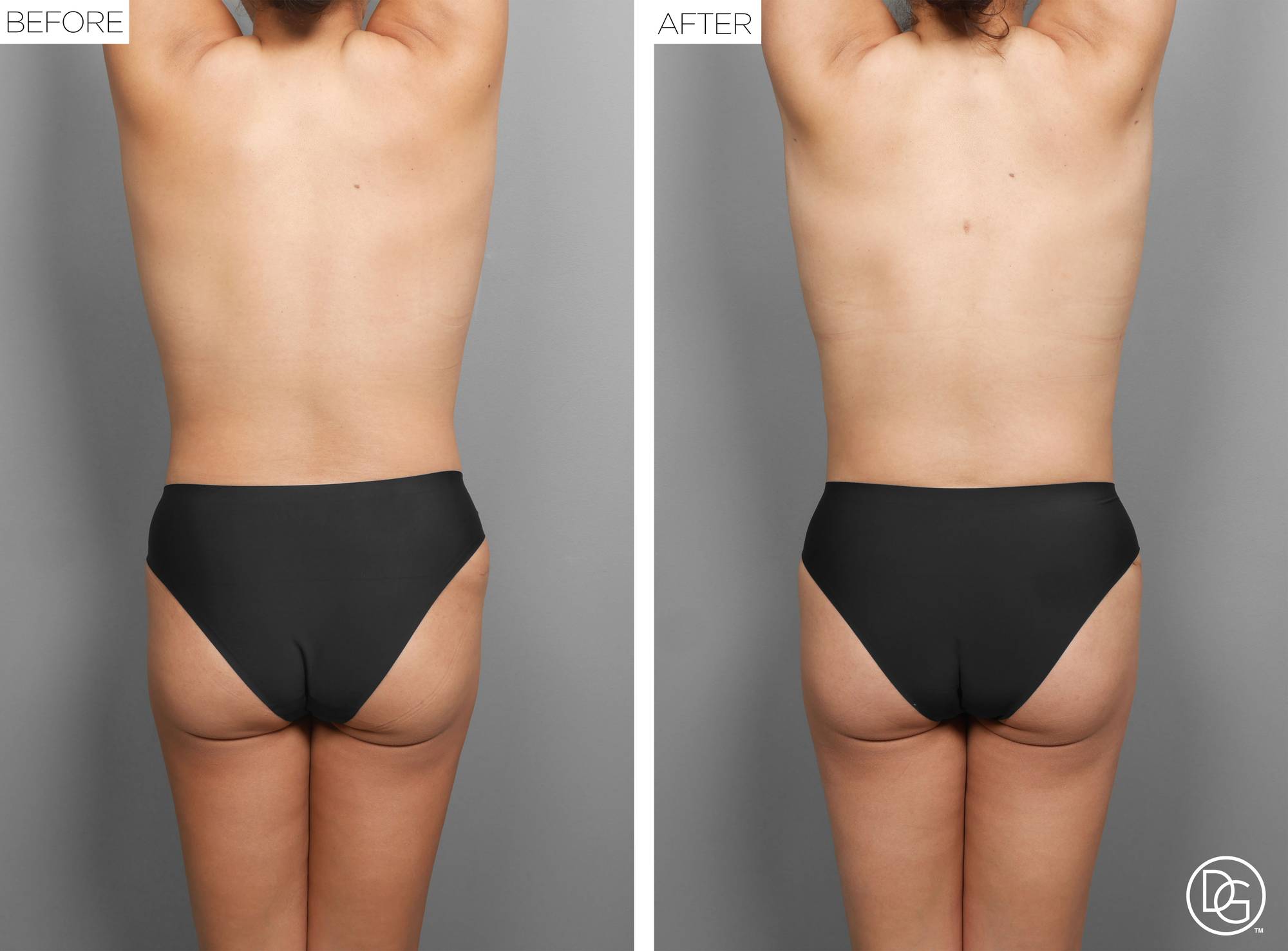 Liposuction Before & After Image