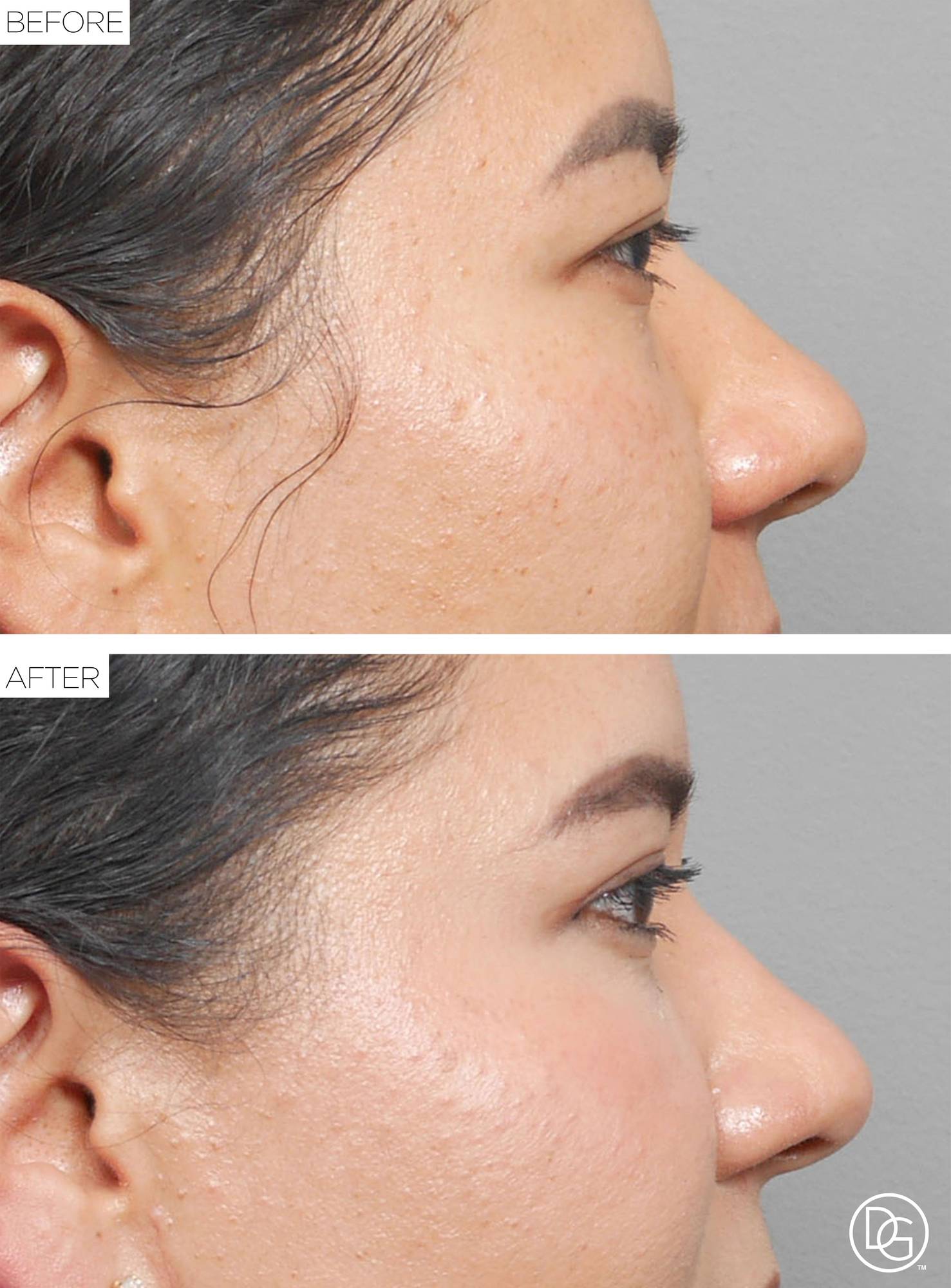 Blepharoplasty Before & After Image