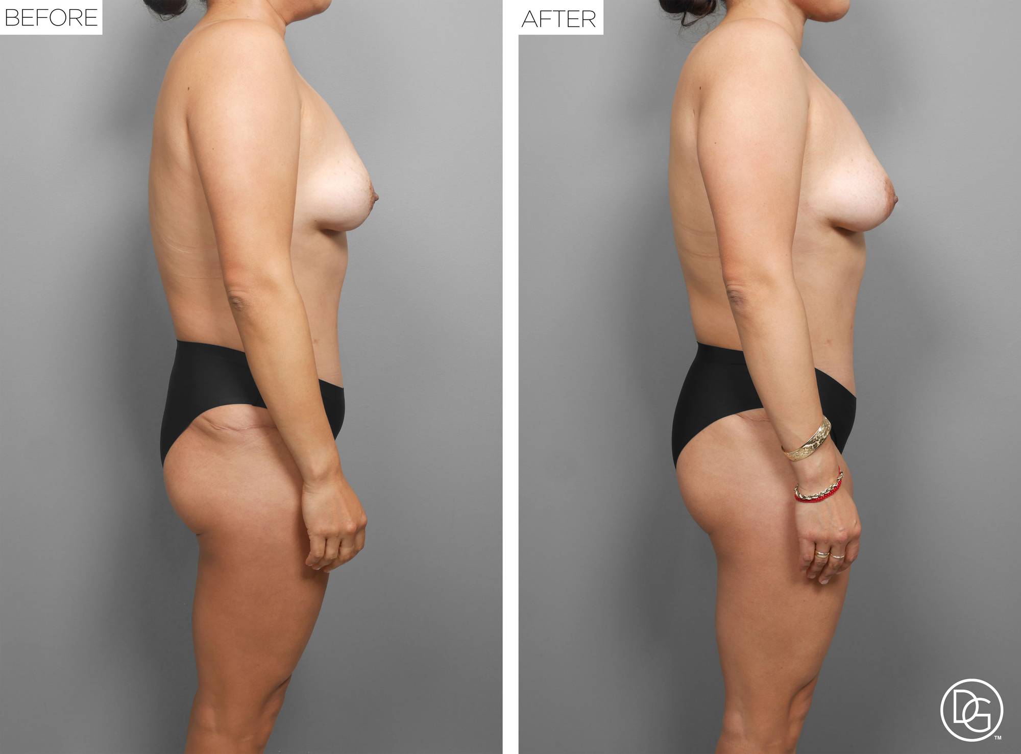 Liposuction Before & After Image